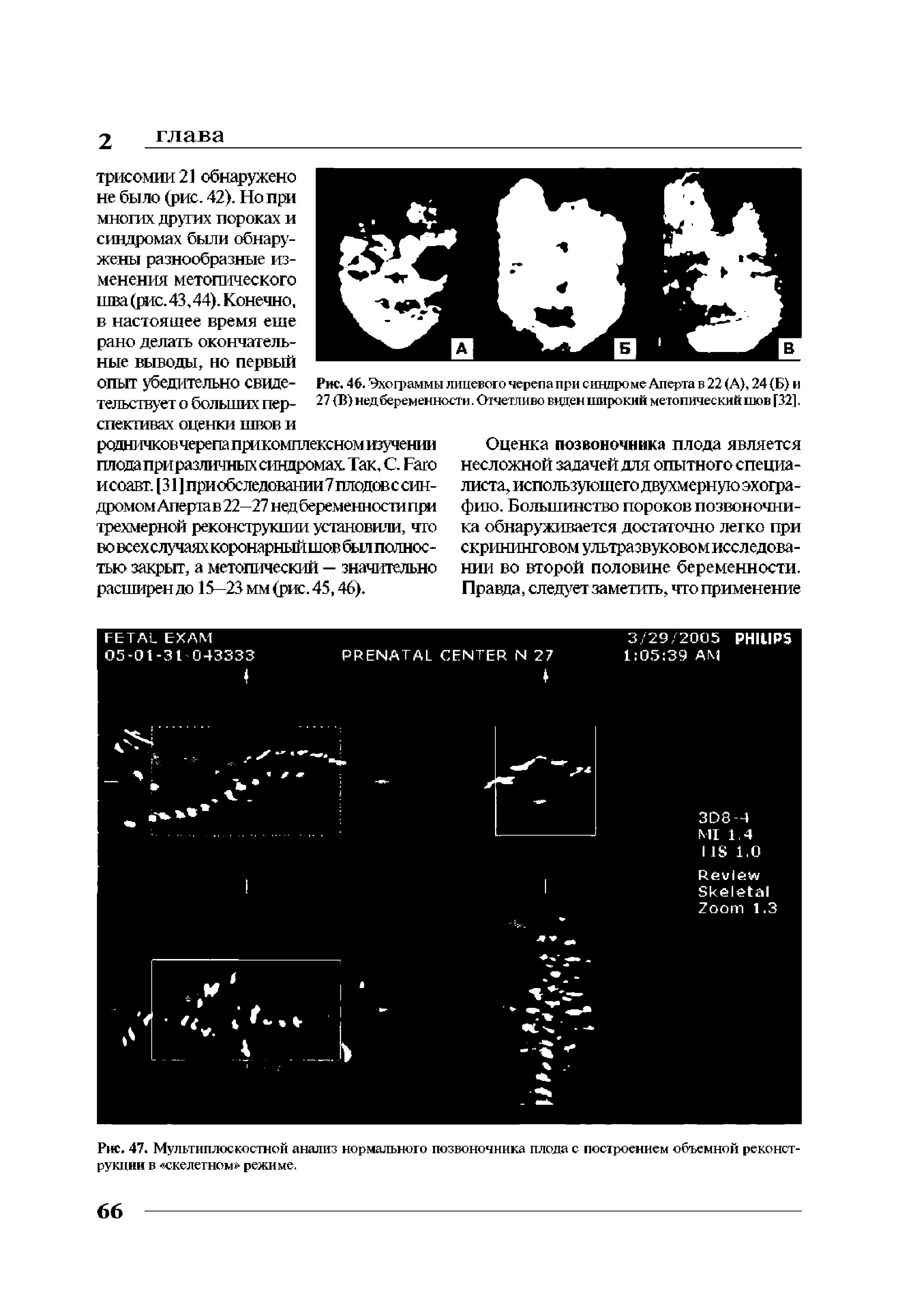 Рис. 46. Эхограммы лицевого черепа при синпро ме Аперта в 22 (А), 24 (Б) и 27 (Б) недбеременности. Отчетливо виден широкий метопический шов [321 ...