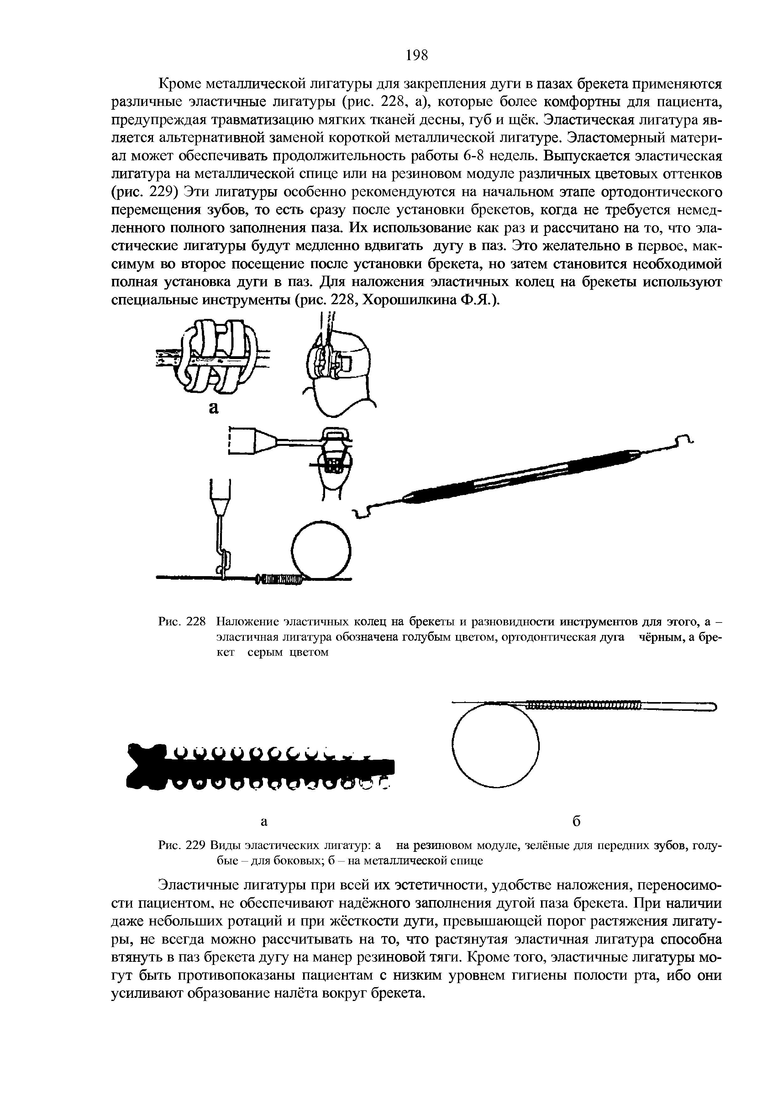 Рис. 228 Наложение эластичных колец на брекеты и разновидности инструментов для этого, а -эластичная лигатура обозначена голубым цветом, ортодонтическая дуга чёрным, а брекет серым цветом...