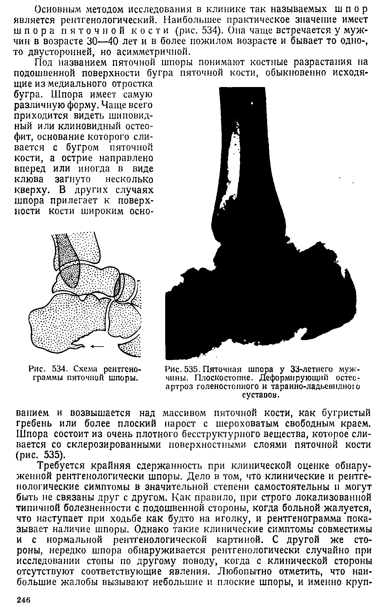 Рис. 535. Пяточная шпора у 33-летнего мужчины. Плоскостопие. Деформирующий остеоартроз голеностопного и таранно-ладьевидною суставов.