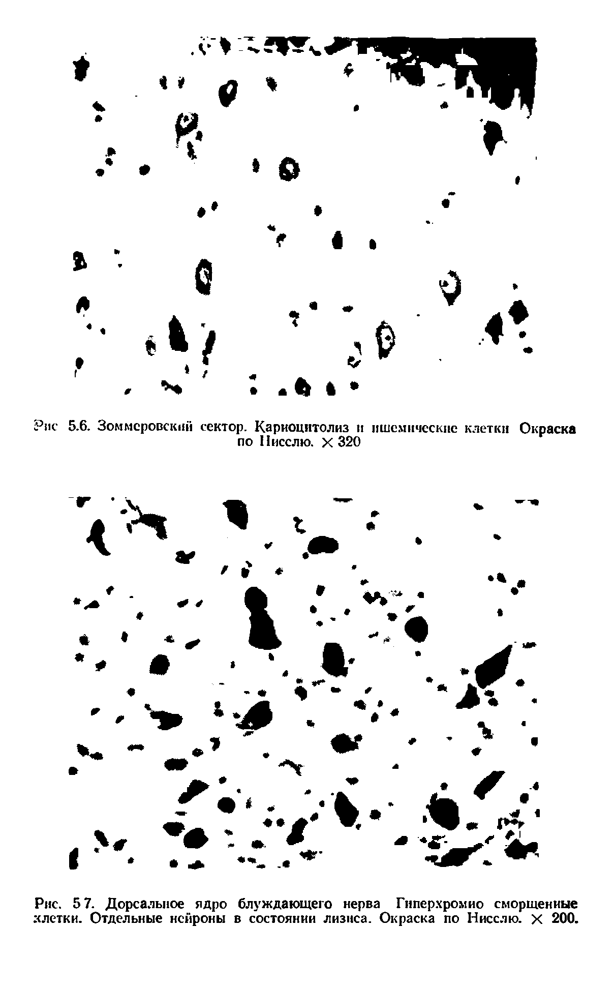 Рис. 5 7. Дорсальное ядро блуждающего нерва Гиперхромио сморщенные клетки. Отдельные нейроны в состоянии лизиса. Окраска по Нисслю. X 200.