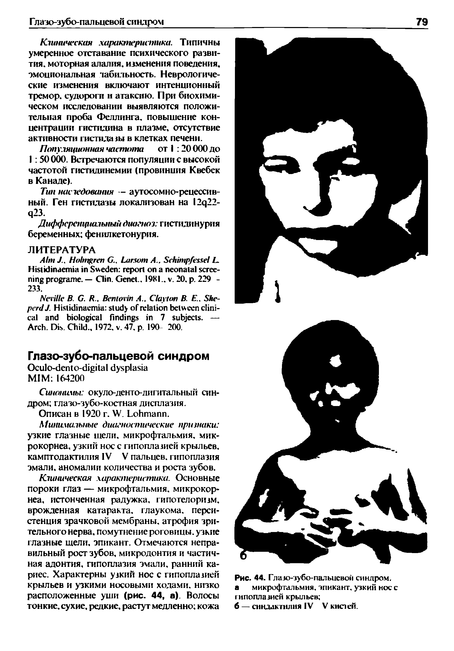 Рис. 44. Глазо-зубо-пальцевой синдром, а микрофтальмия, эпикант, узкий нос с гипоплазией крыльев ...