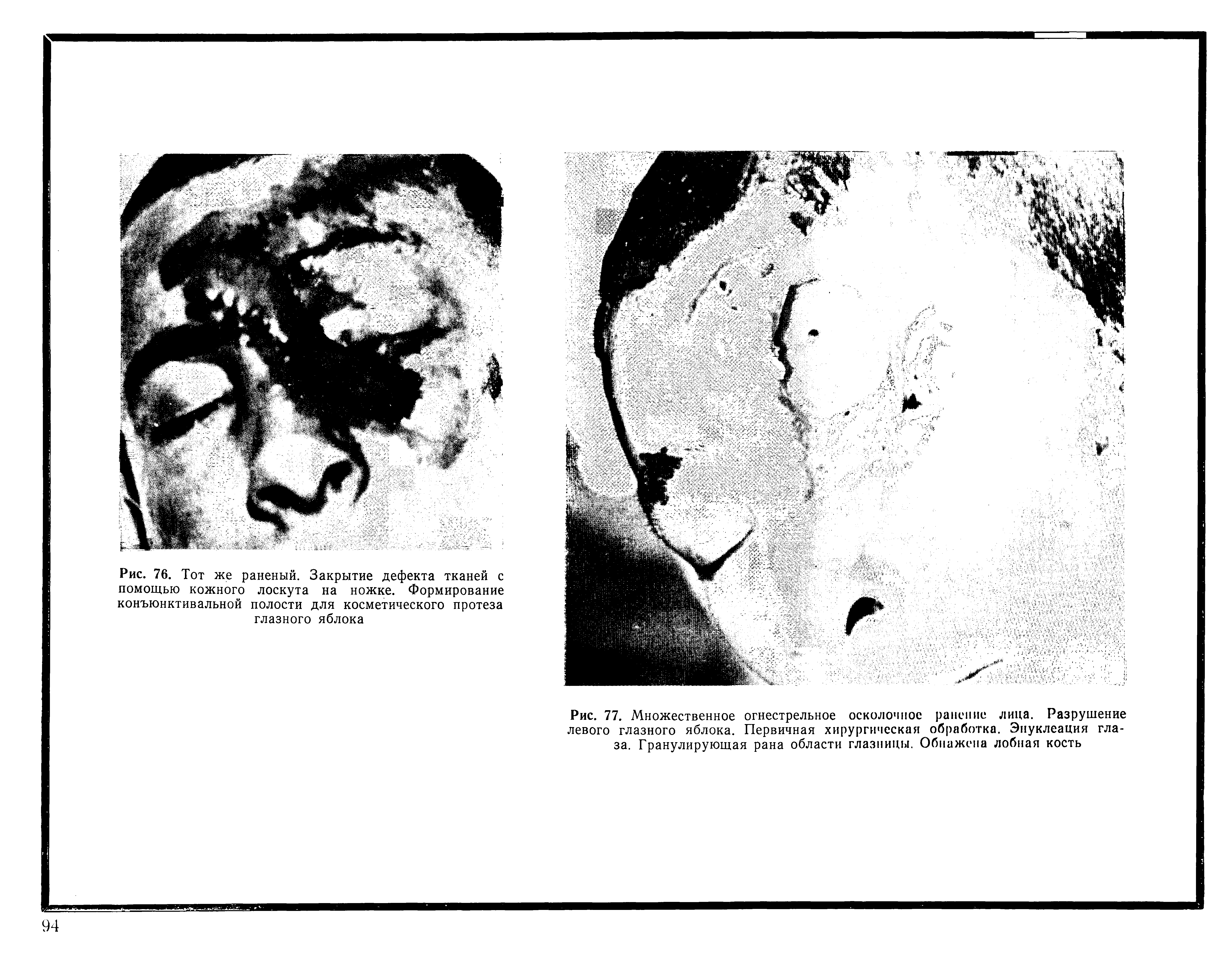 Рис. 77. Множественное огнестрельное осколочное ранение лица. Разрушение левого глазного яблока. Первичная хирургическая обработка. Энуклеация глаза. Гранулирующая рана области глазницы. Обнажена лобная кость...