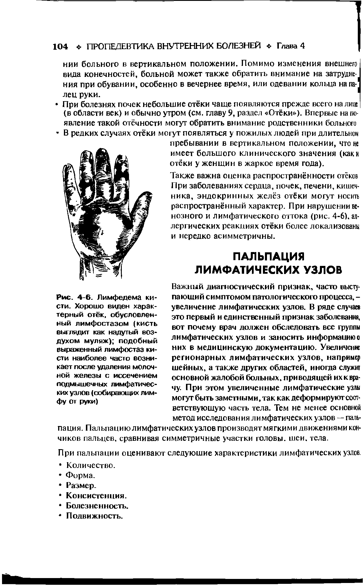 Рис. 4-6. Лимфедема кисти. Хорошо виден характерный отёк, обусловленный лимфостазом (кисть выглядит как надутый воздухом муляж) подобный выраженный лимфостаз кисти наиболее часто возникает после удаления молочной железы с иссечением подмышечных лимфатических узлов (собирающих лимфу от руки)...