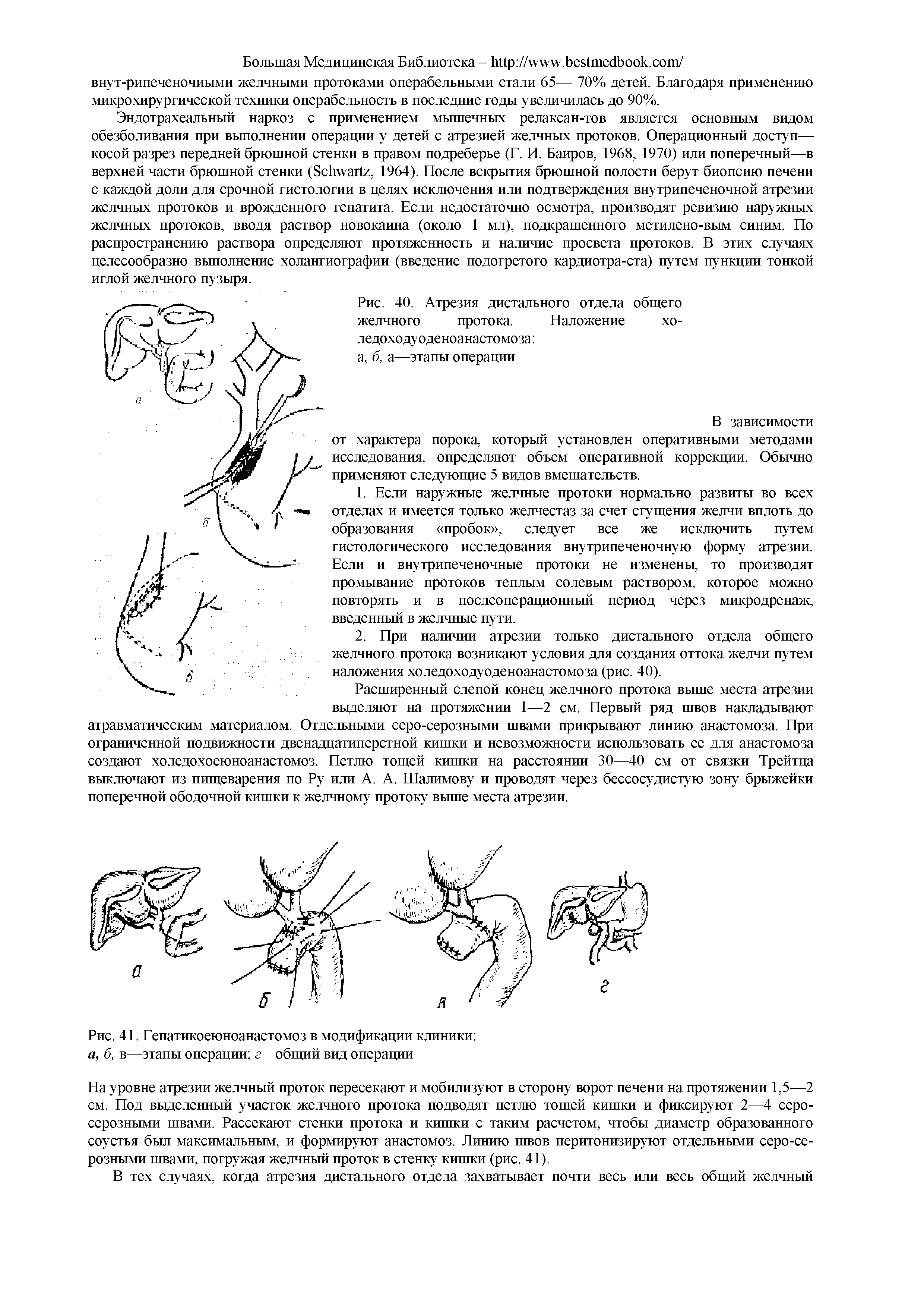 Рис. 41. Гепатикоеюноанастомоз в модификации клиники а, б, в—этапы операции г—общий вид операции...