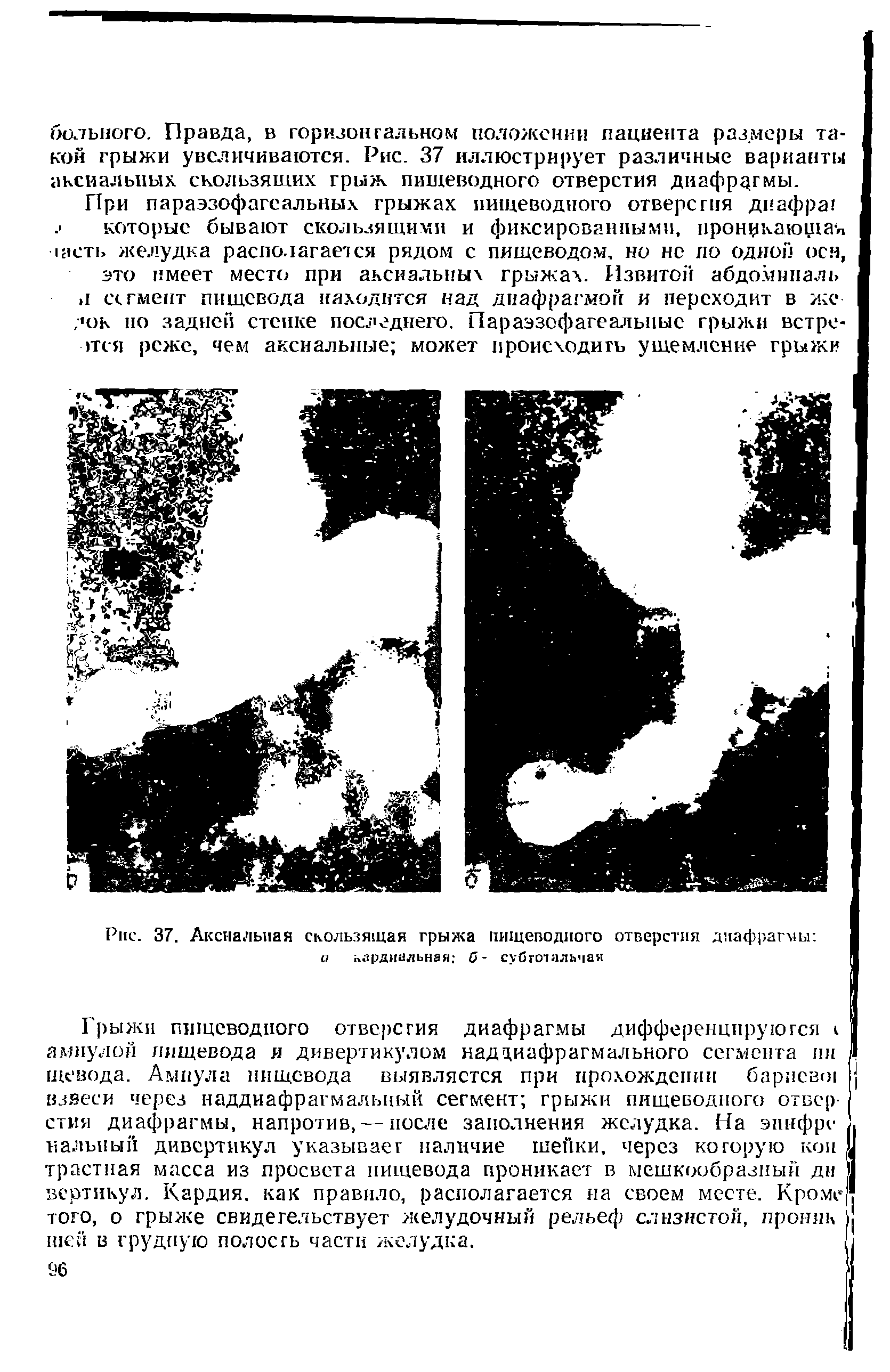 Рис. 37. Аксиальная скользящая грыжа пищеводного отверстия диафрагмы а кардиальная б- субготальчая...