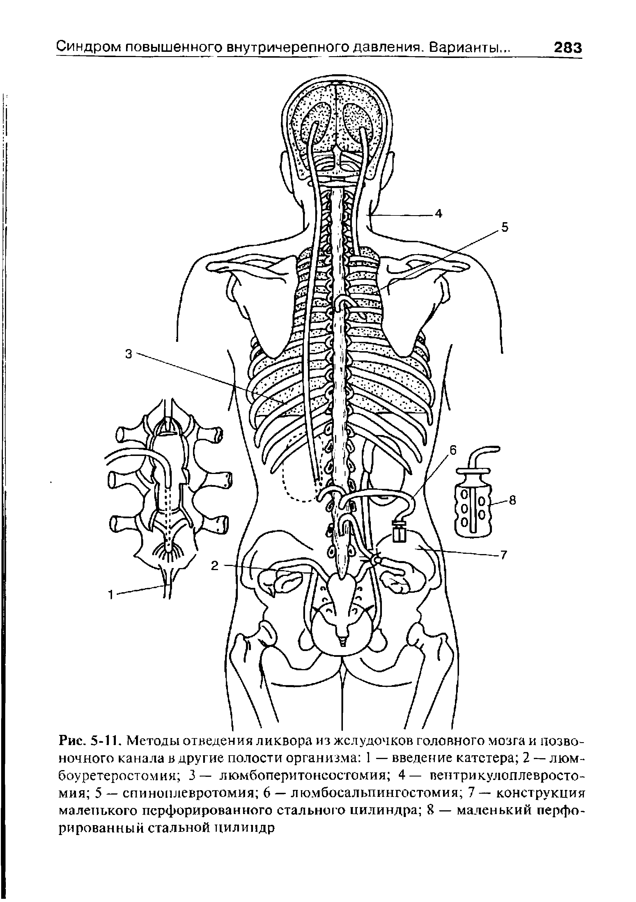 Рис. 5-11. Методы отведения ликвора из желудочков головного мозга и позвоночного канала в другие полости организма 1 — введение катетера 2 — люм-боуретеростомия 3— люмбоперитонеостомия 4— вентрикулоплевросто-мия 5 — спиноплевротомия 6 — люмбосальпингостомия 7 — конструкция маленького перфорированного стального цилиндра 8 — маленький перфорированный стальной цилиндр...