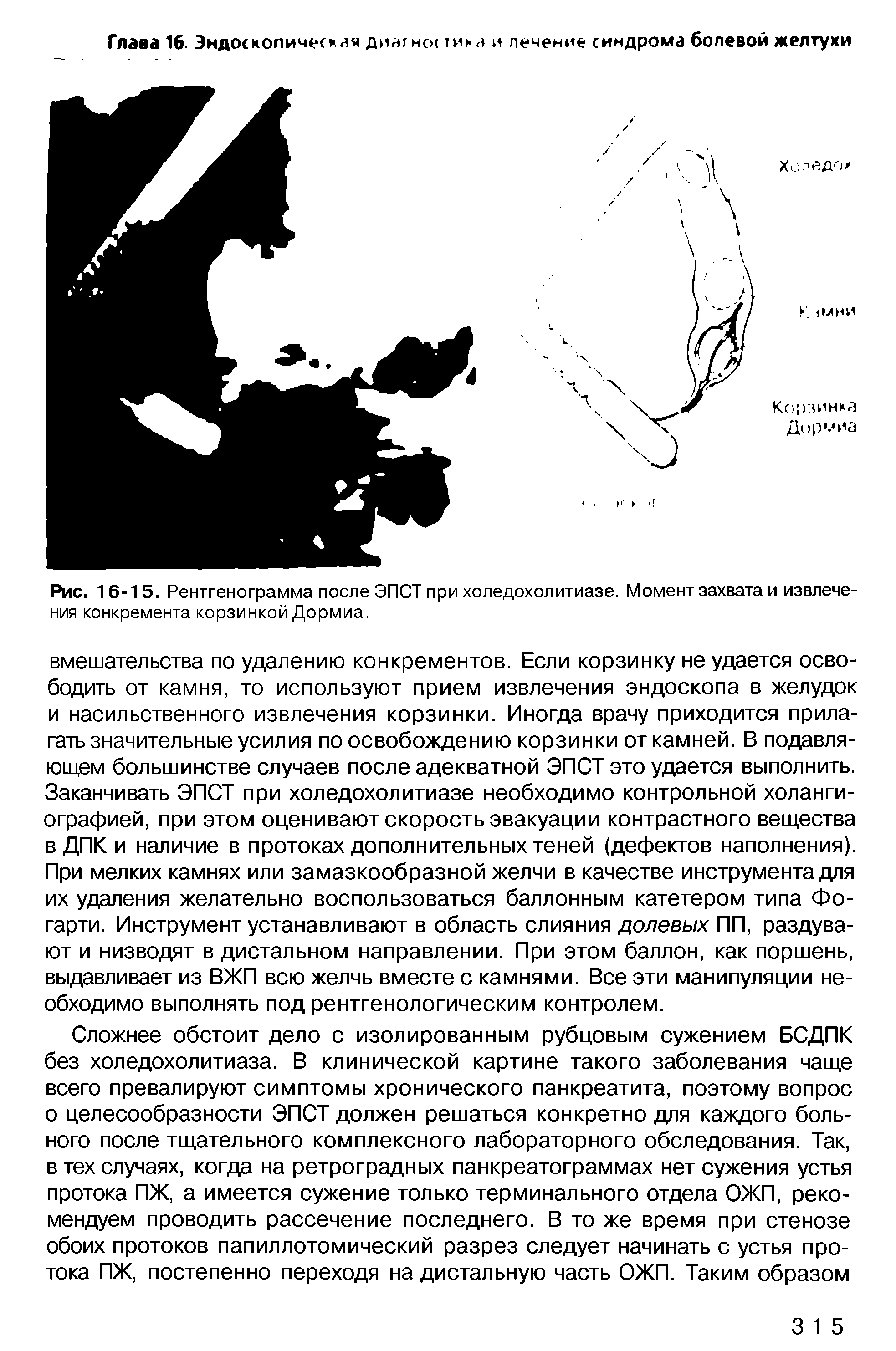 Рис. 16-15. Рентгенограмма после ЭПСТ при холедохолитиазе. Момент захвата и извлечения конкремента корзинкой Дормиа.