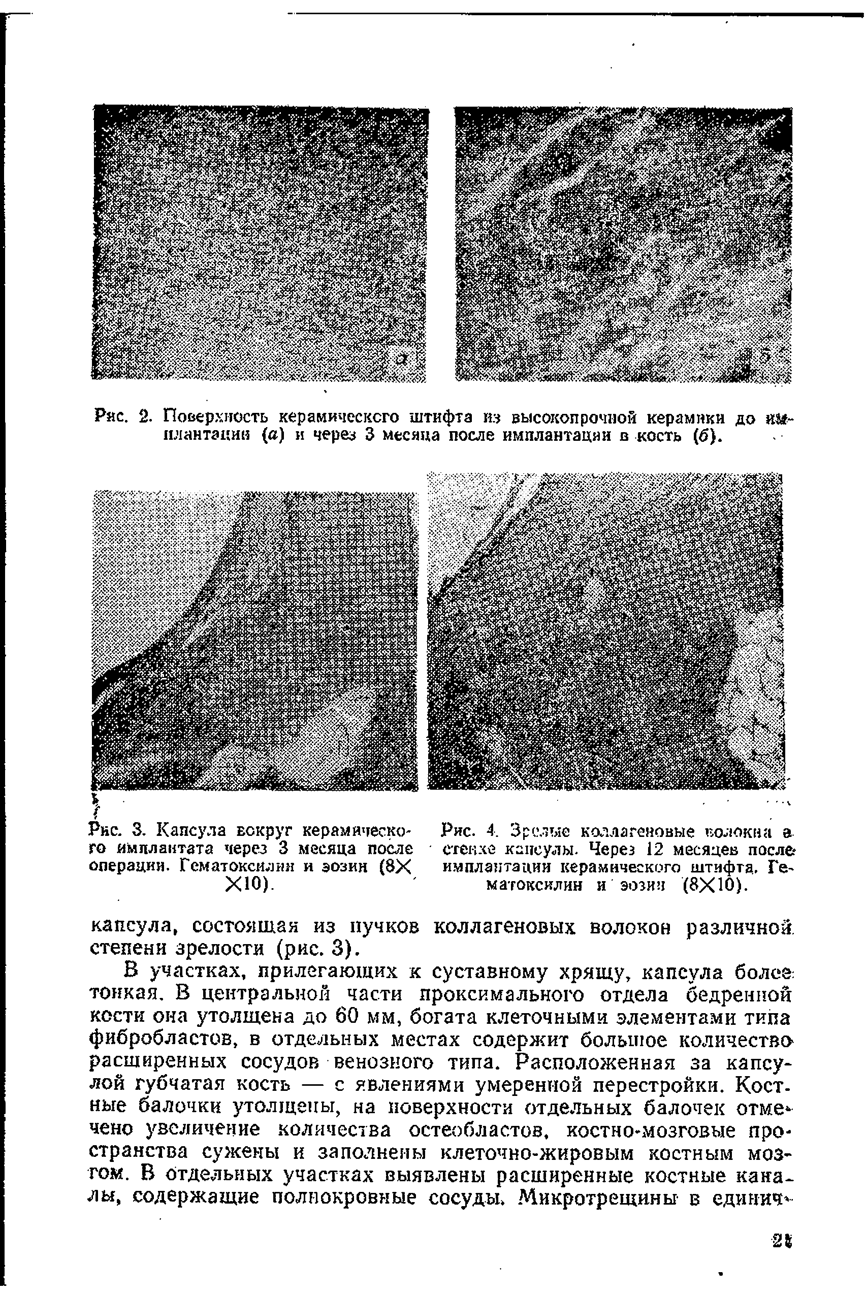 Рис. 3. Капсула вокруг керамическое Рис. 4. Зрелые коллагеновые волокна а го имплантата через 3 месяца после стекхе капсулы. Через 12 месяцев после. операции. Гематоксилин и эозин (8Х имплантации керамического штифта, Ге-...