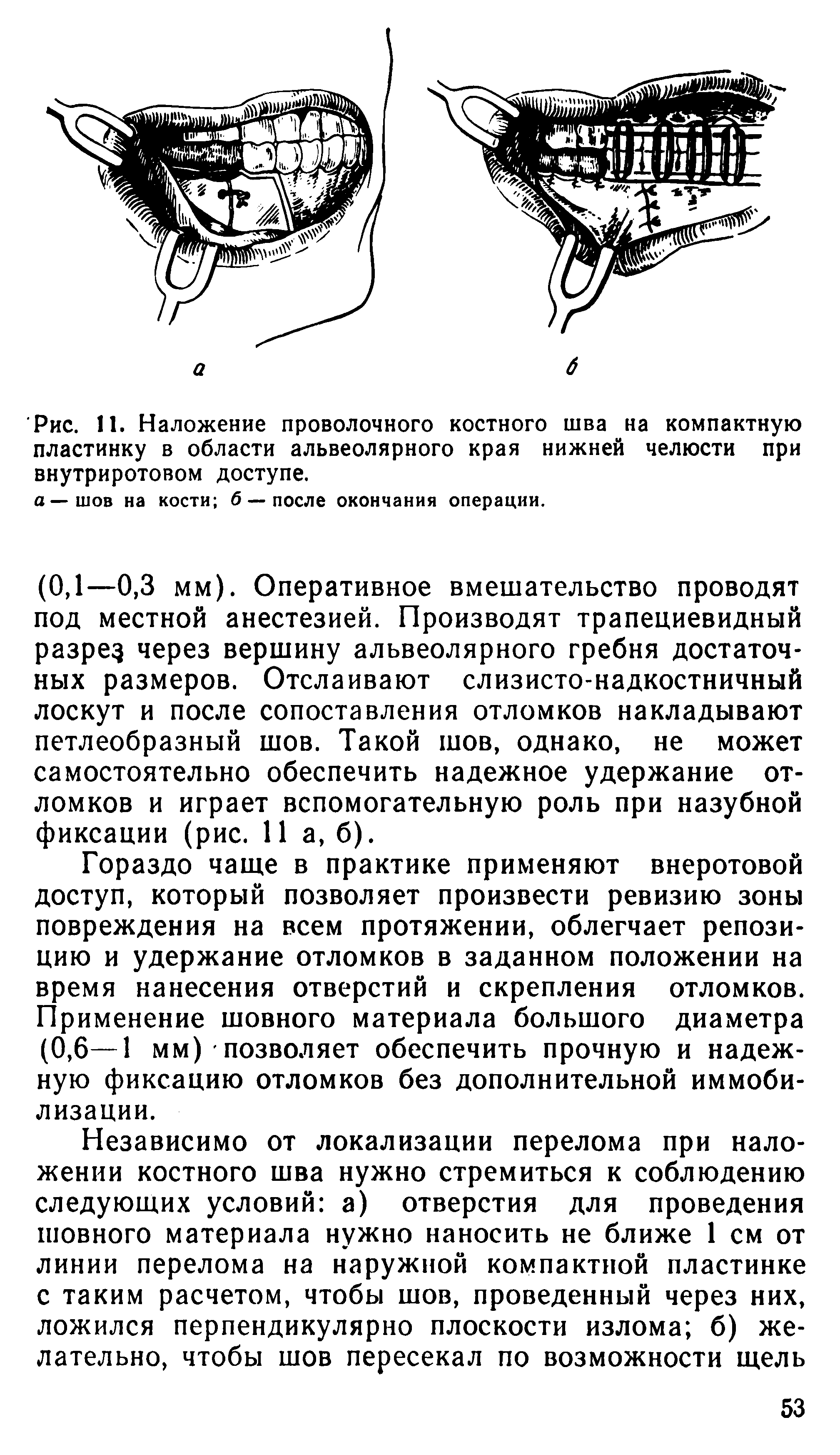 Рис. 11. Наложение проволочного костного шва на компактную пластинку в области альвеолярного края нижней челюсти при внутриротовом доступе.