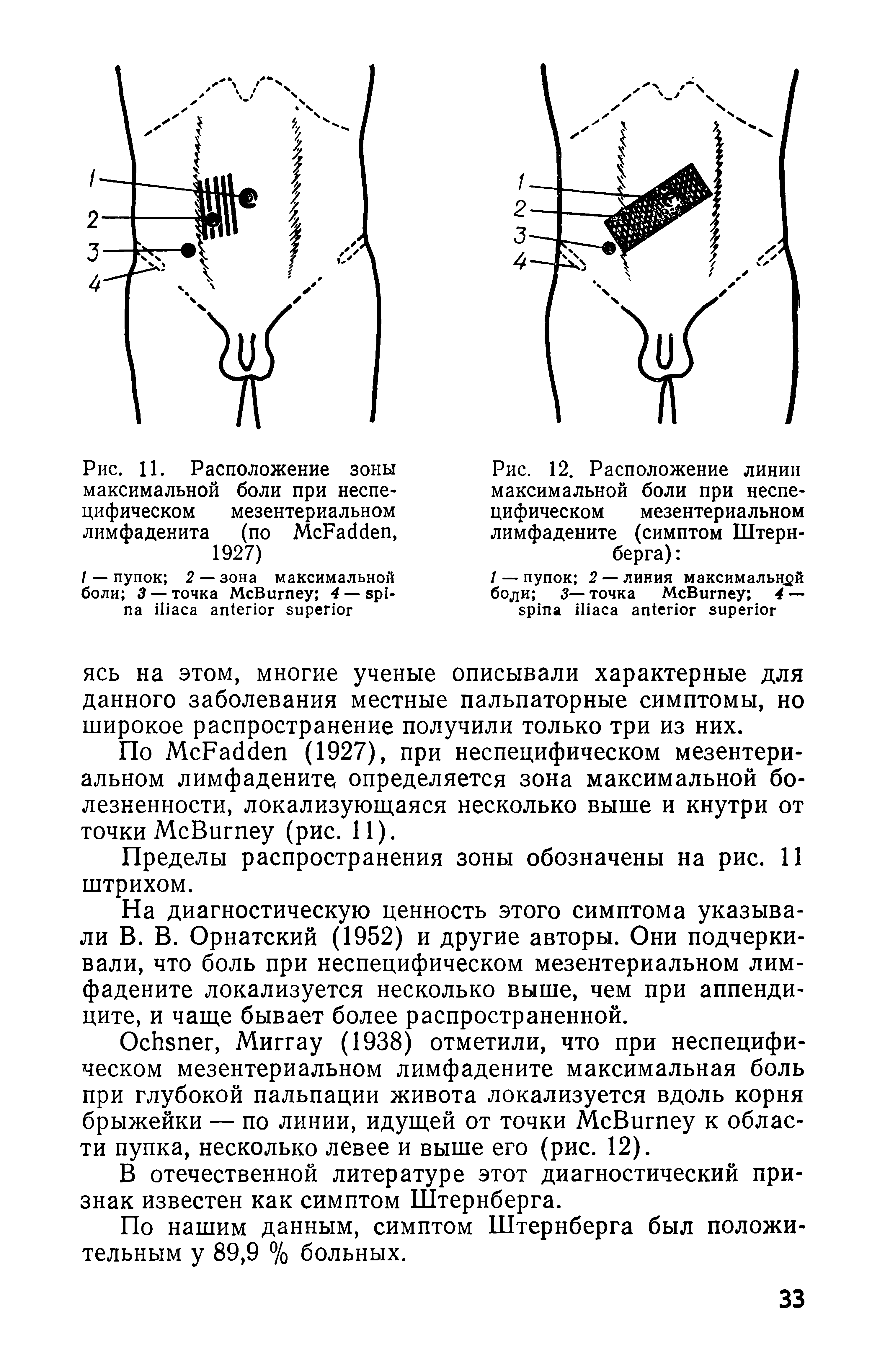 Рис. 12. Расположение линии максимальной боли при неспецифическом мезентериальном лимфадените (симптом Штернберга) ...