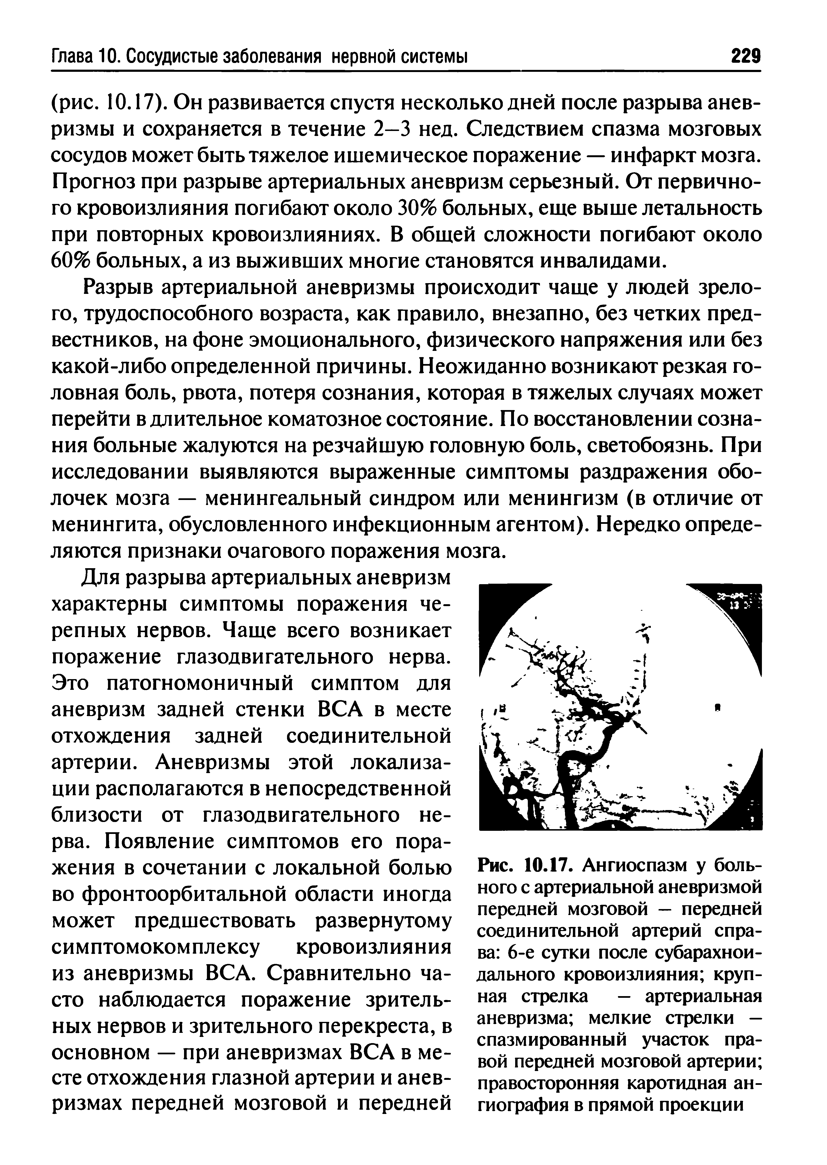 Рис. 10.17. Ангиоспазм у больного с артериальной аневризмой передней мозговой — передней соединительной артерий справа 6-е сутки после субарахноидального кровоизлияния круп-...