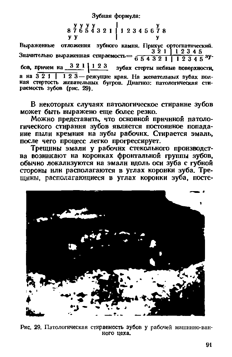 Рис. 29. Патологическая стираемость зубов у рабочей машинно-ванного цеха.