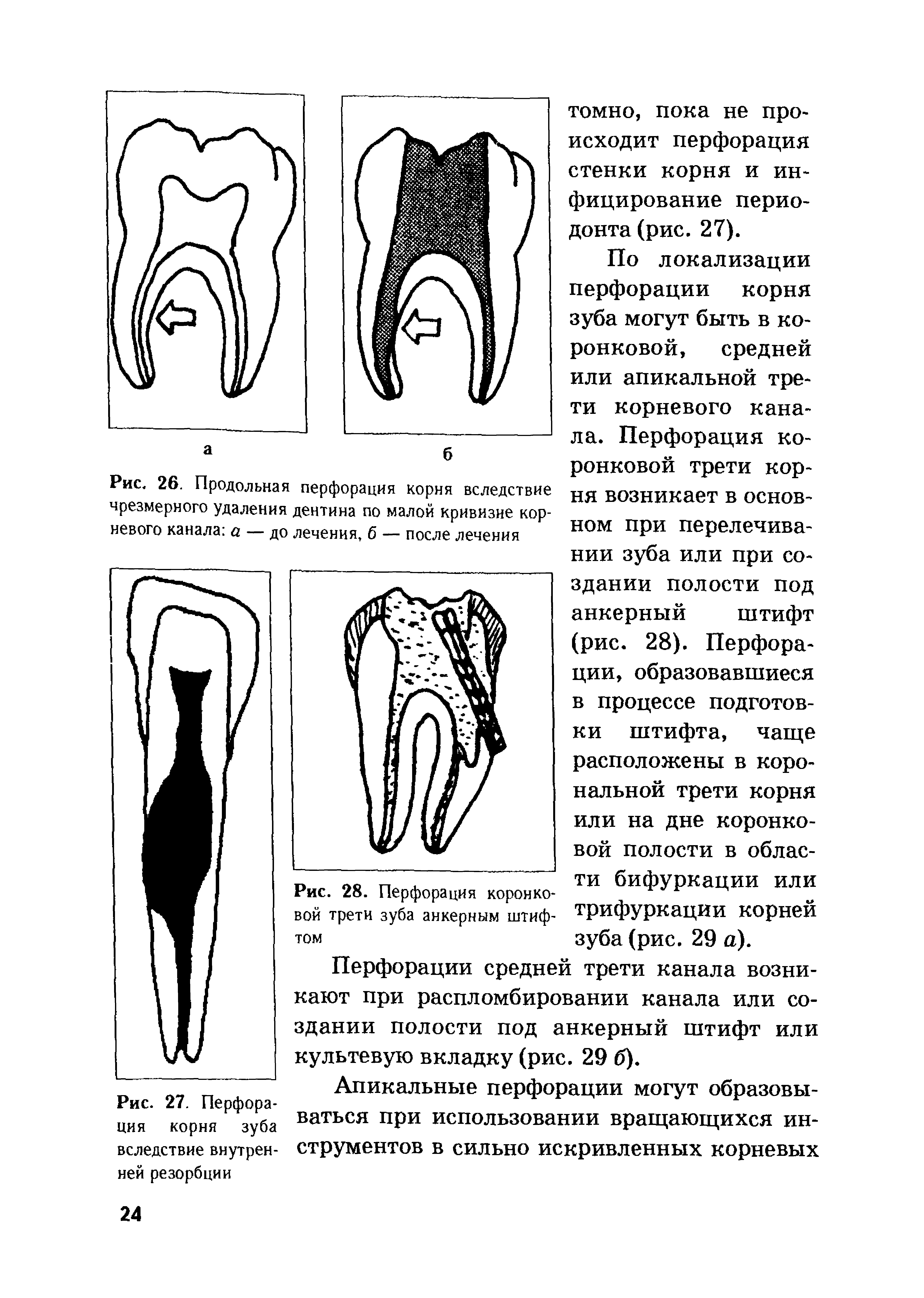 Рис. 28. Перфорация коронковой трети зуба анкерным штифтом...