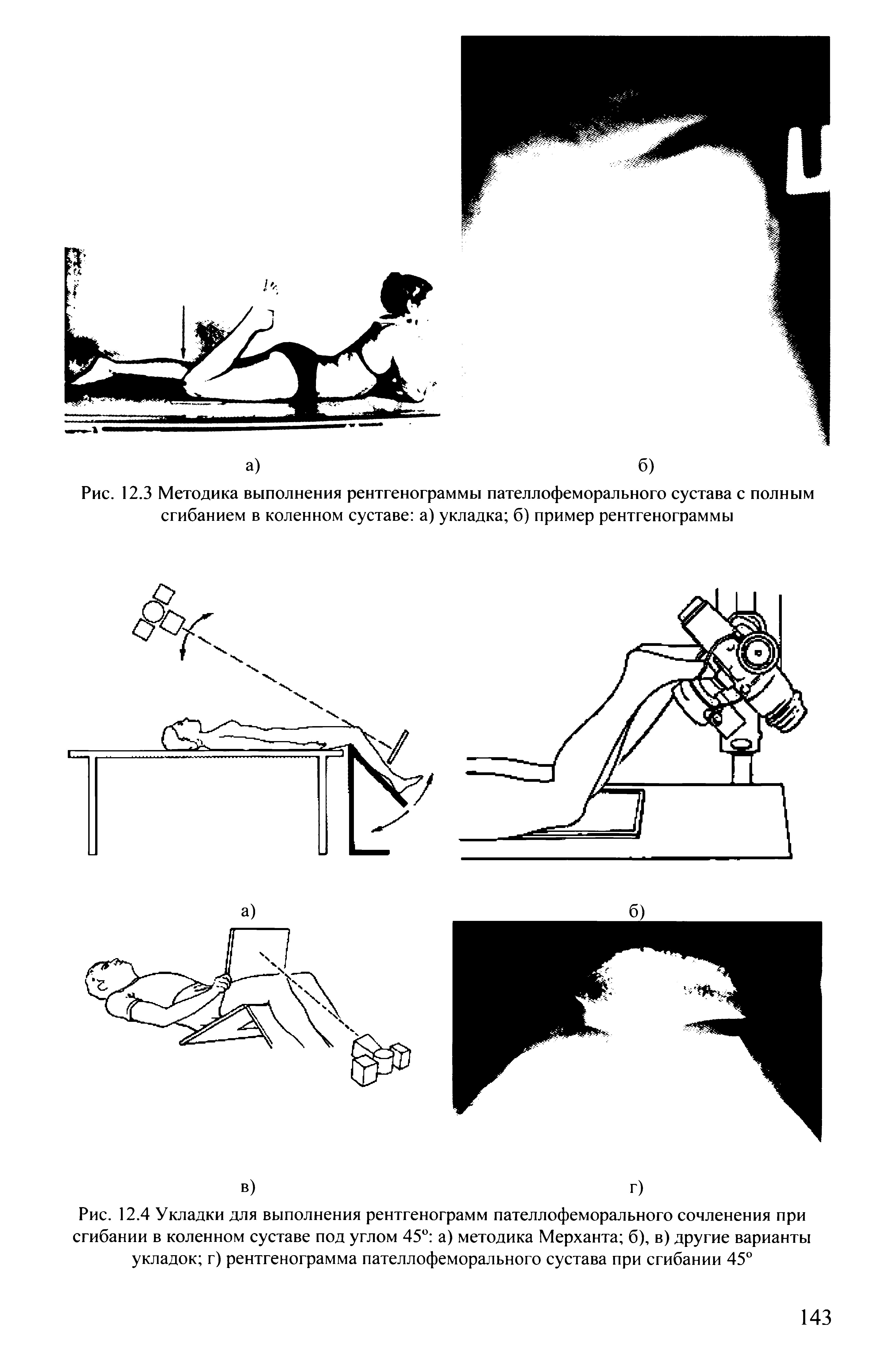 Рис. 12.3 Методика выполнения рентгенограммы пателлофеморального сустава с полным сгибанием в коленном суставе а) укладка б) пример рентгенограммы...