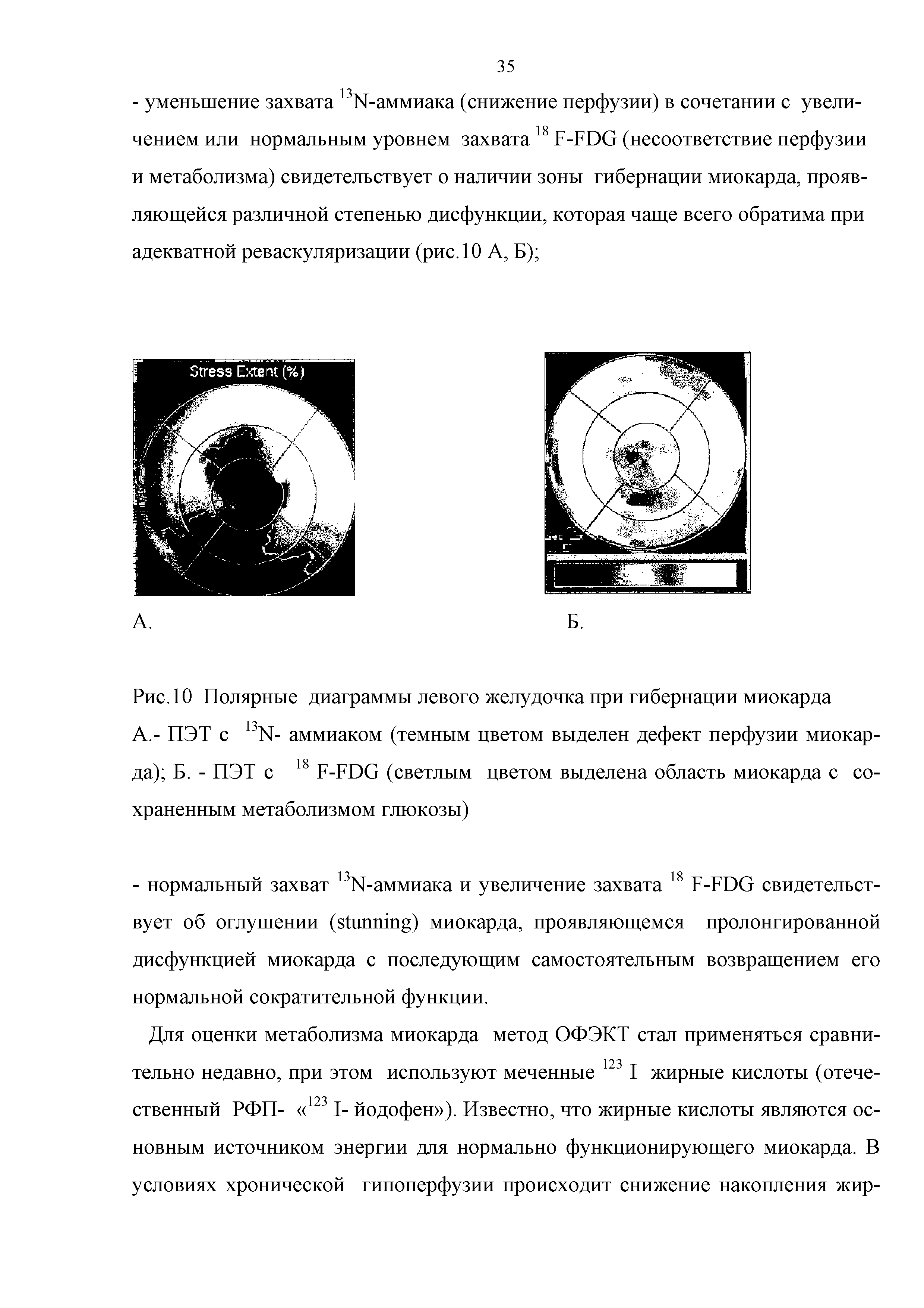 Рис. 10 Полярные диаграммы левого желудочка при гибернации миокарда А,- ПЭТ с 13N- аммиаком (темным цветом выделен дефект перфузии миокарда) Б. - ПЭТ с 18 F-FDG (светлым цветом выделена область миокарда с сохраненным метаболизмом глюкозы)...