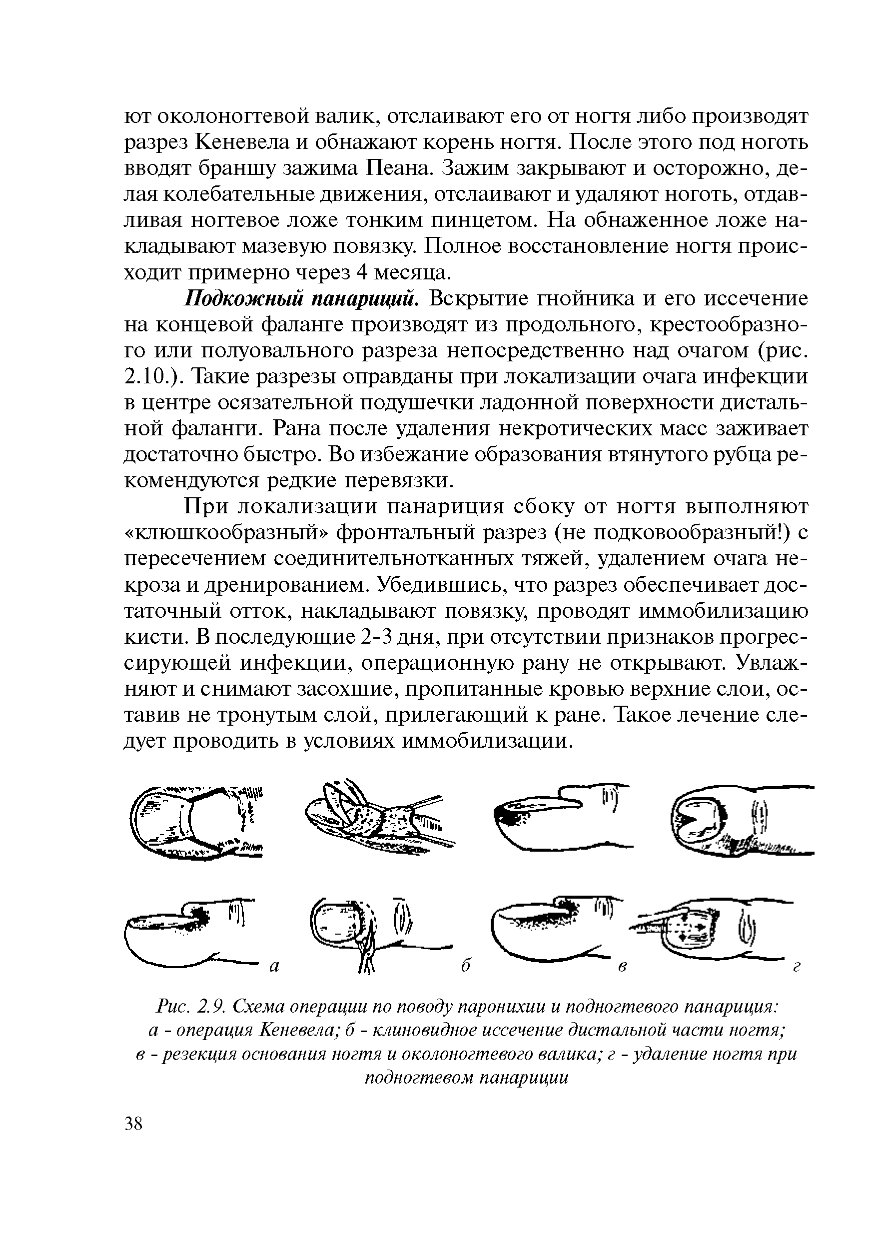 Рис. 2.9. Схема операции по поводу паронихии и подногтевого панариция а - операция Кеневела б - клиновидное иссечение дистальной части ногтя в - резекция основания ногтя и околоногтевого валика г - удаление ногтя при подногтевом панариции...