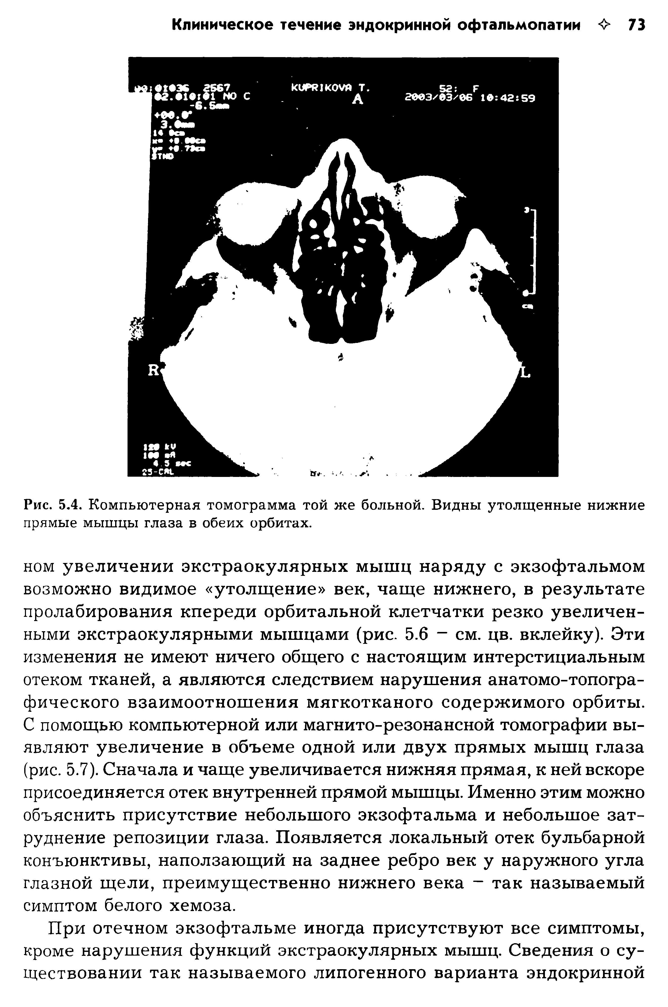 Рис. 5.4. Компьютерная томограмма той же больной. Видны утолщенные нижние прямые мышцы глаза в обеих орбитах.