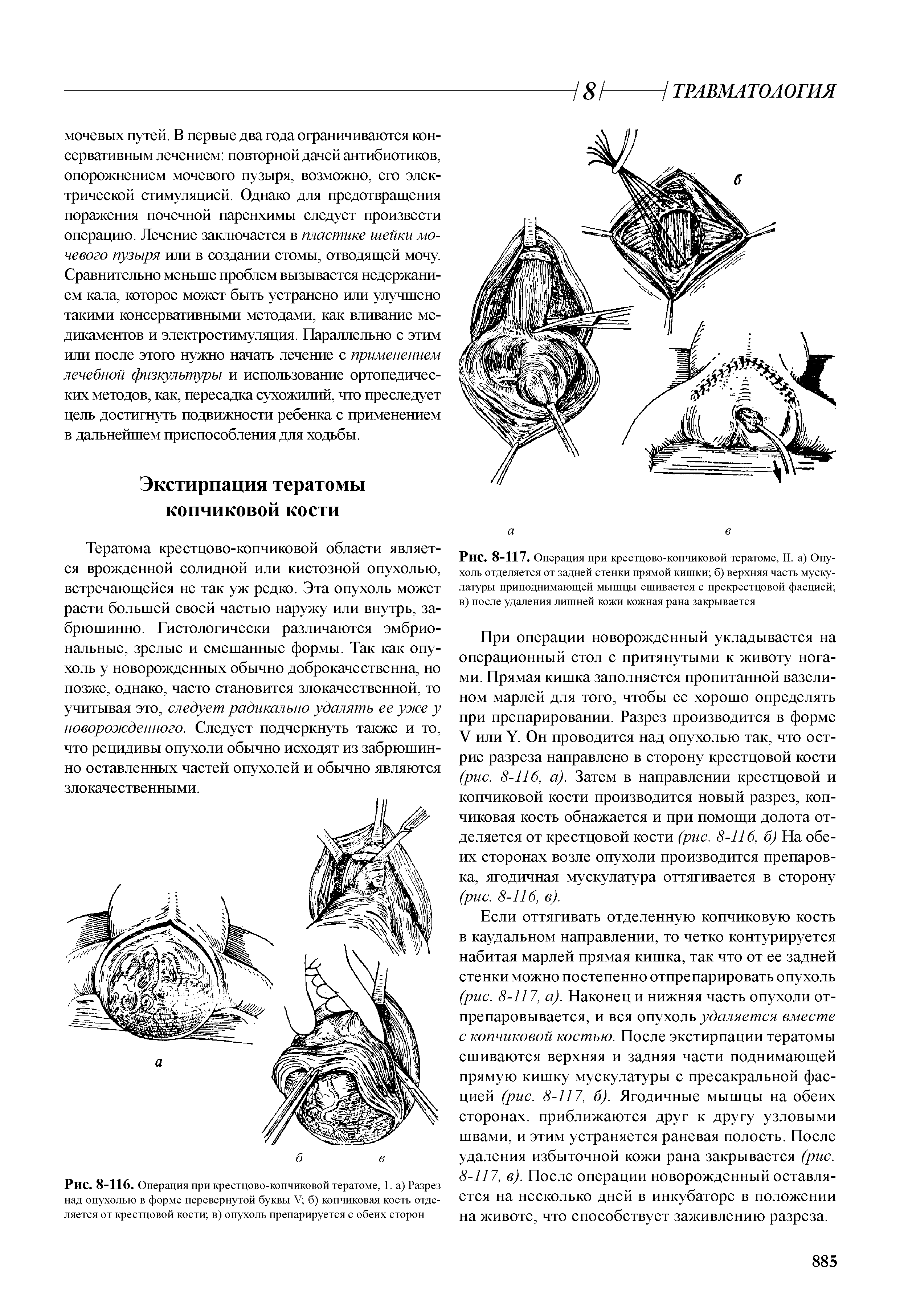 Рис. 8-117. Операция при крестцово-копчиковой тератоме, II. а) Опухоль отделяется от задней стенки прямой кишки б) верхняя часть мускулатуры приподнимающей мышцы сшивается с прекрестцовой фасцией в) после удаления лишней кожи кожная рана закрывается...