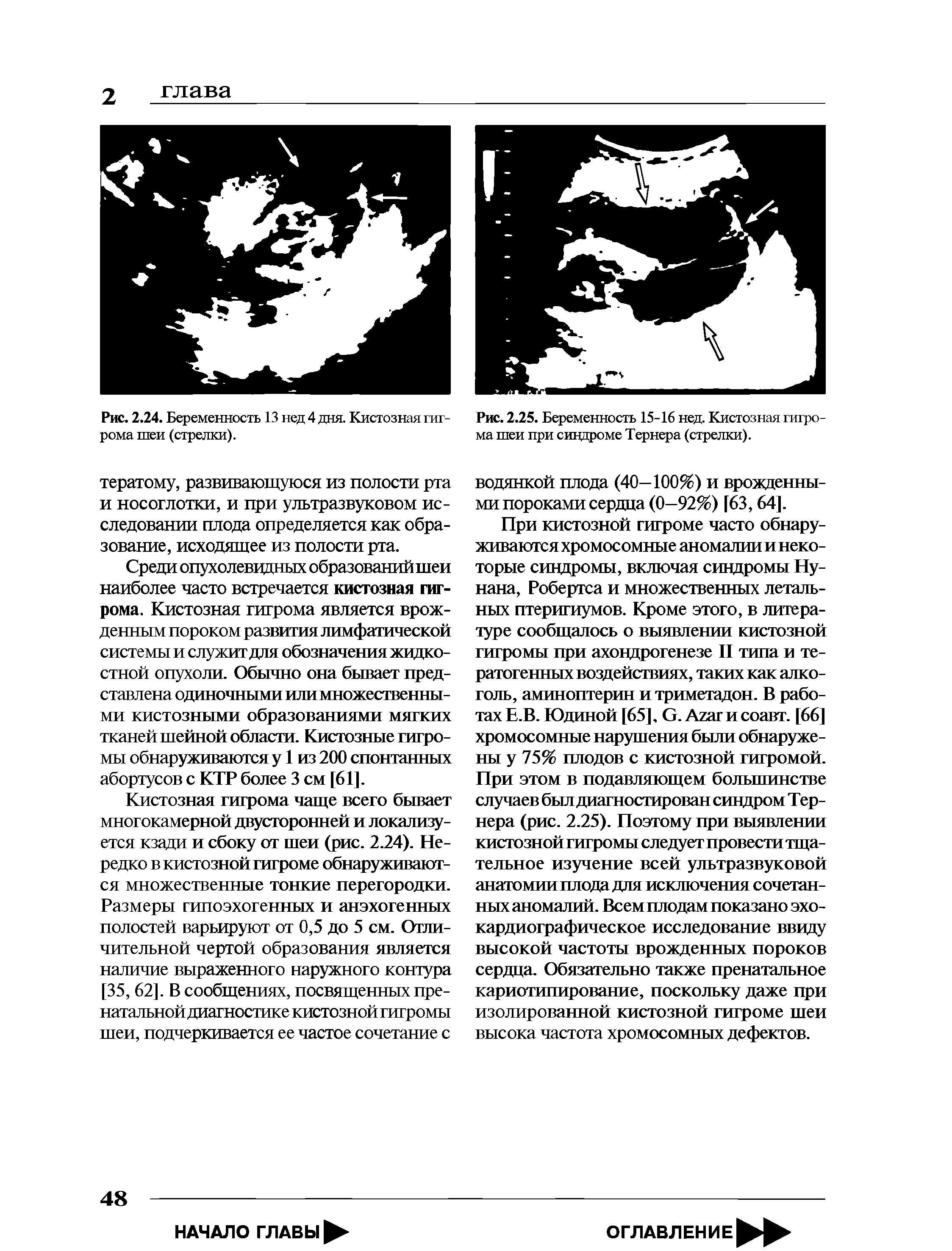 Рис. 2.25. Беременность 15-16 нед. Кистозная гигрома шеи при синдроме Тернера (стрелки).