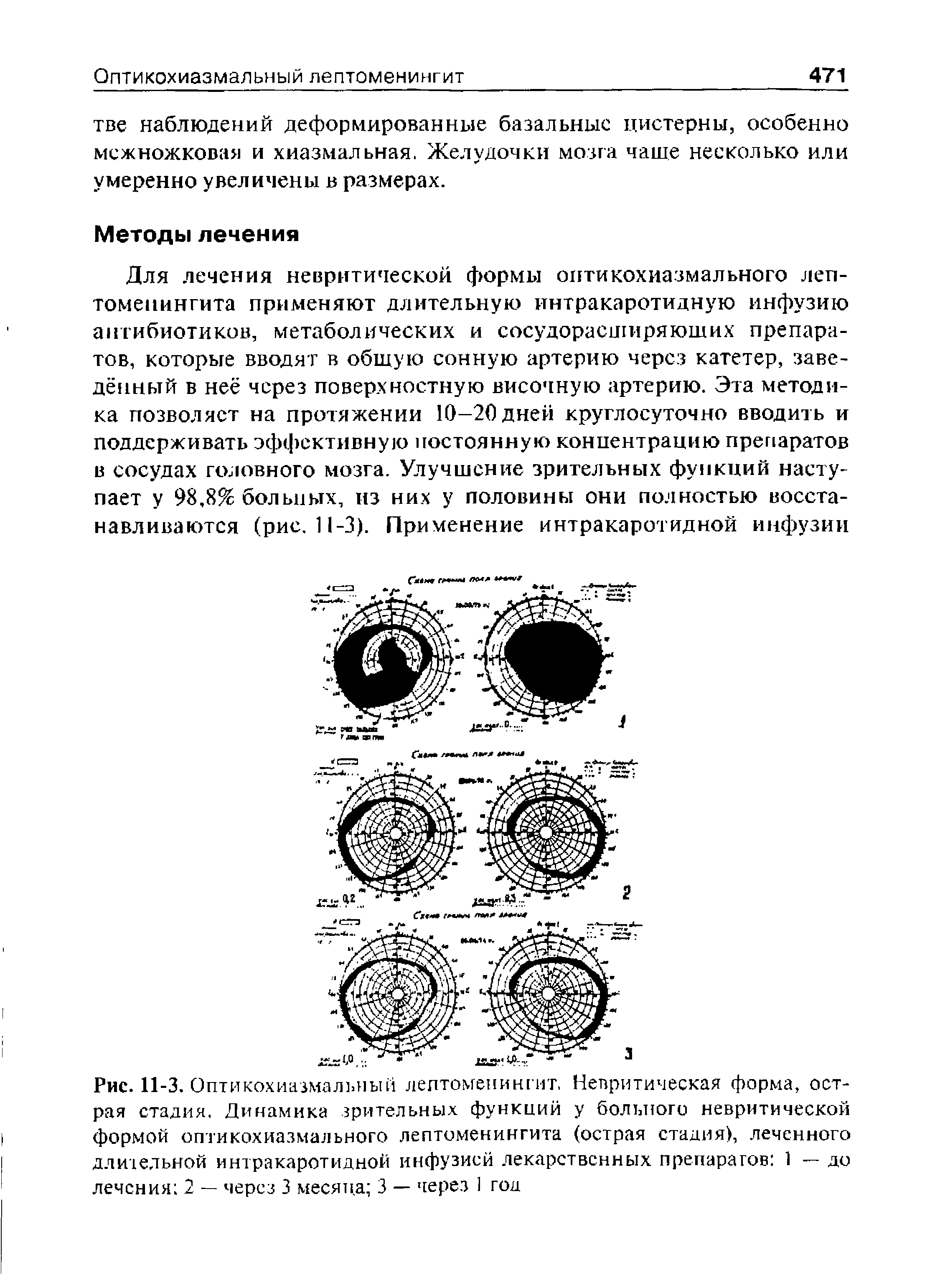 Рис. 11-3. Оптикохиазмалъиый лептоменингит, Невритическая форма, острая стадия. Динамика зрительных функций у больного невритической формой оптикохиазмального лептоменингита (острая стадия), леченного длительной интракаротидной инфузией лекарственных препарагов 1 — до лечения 2 — через 3 месяца 3 — через 1 год...