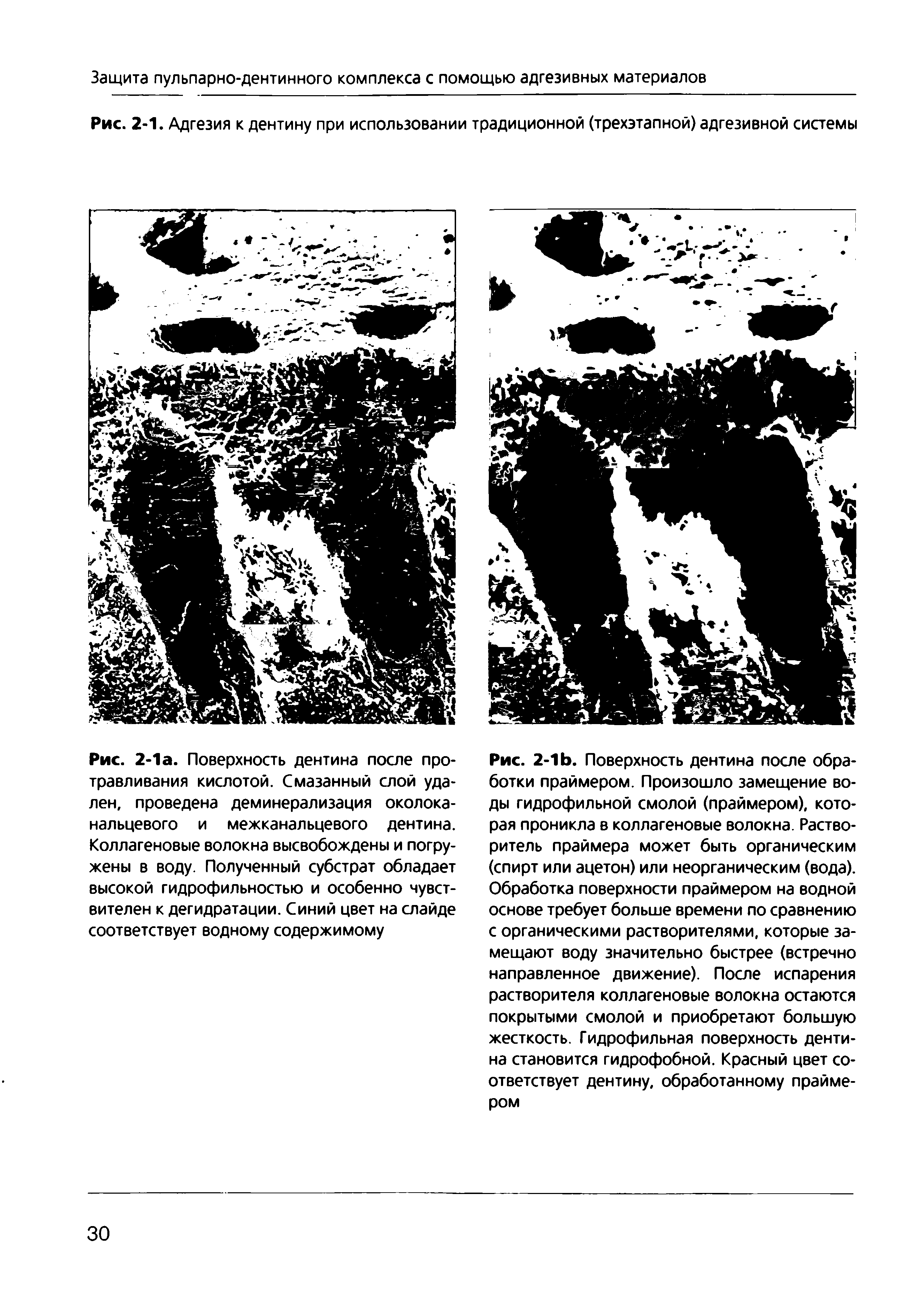 Рис. 2-1. Адгезия к дентину при использовании традиционной (трехэтапной) адгезивной системы...