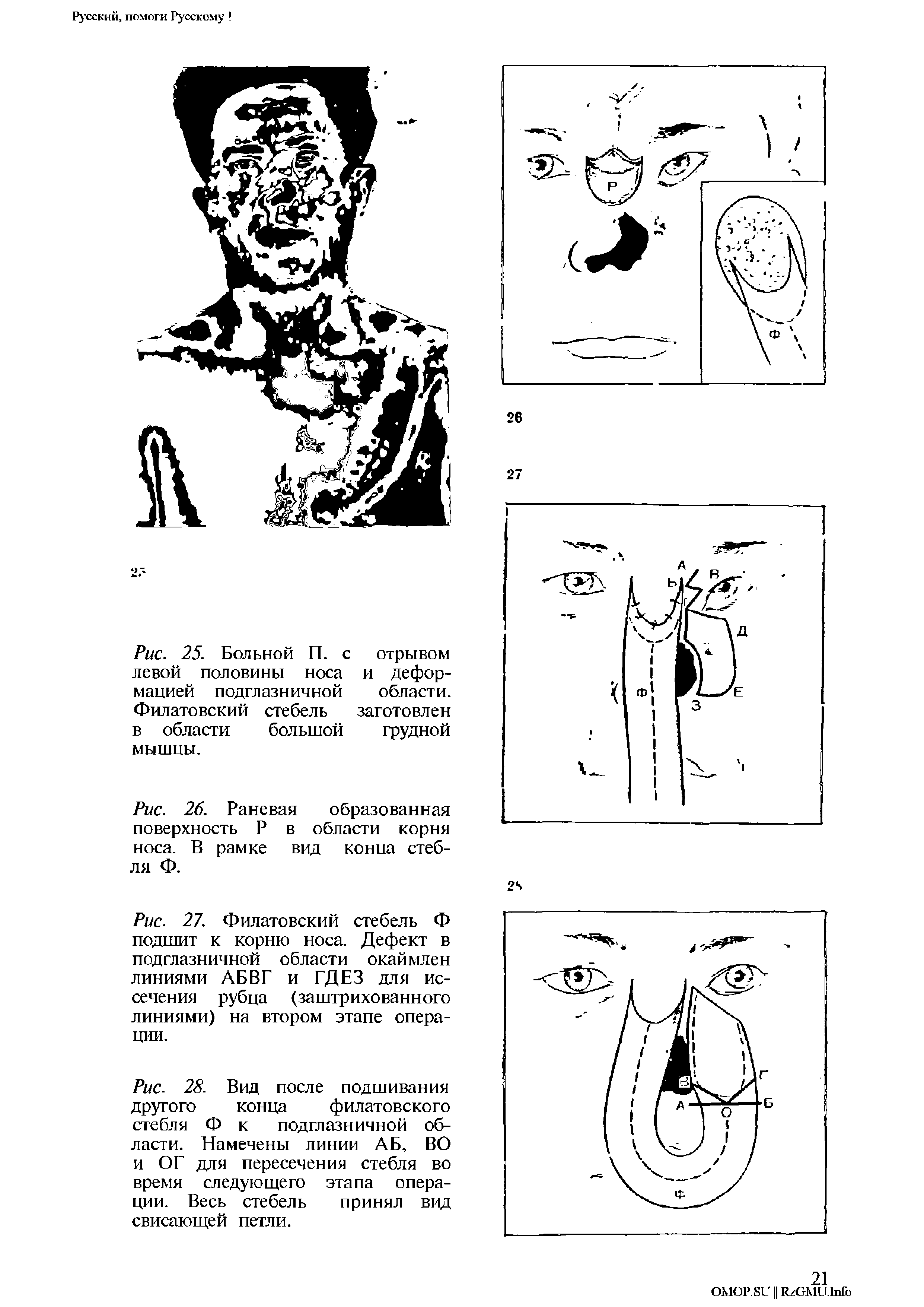 Рис. 25. Больной П. с отрывом левой половины носа и деформацией подглазничной области. Филатовский стебель заготовлен в области большой грудной мышцы.