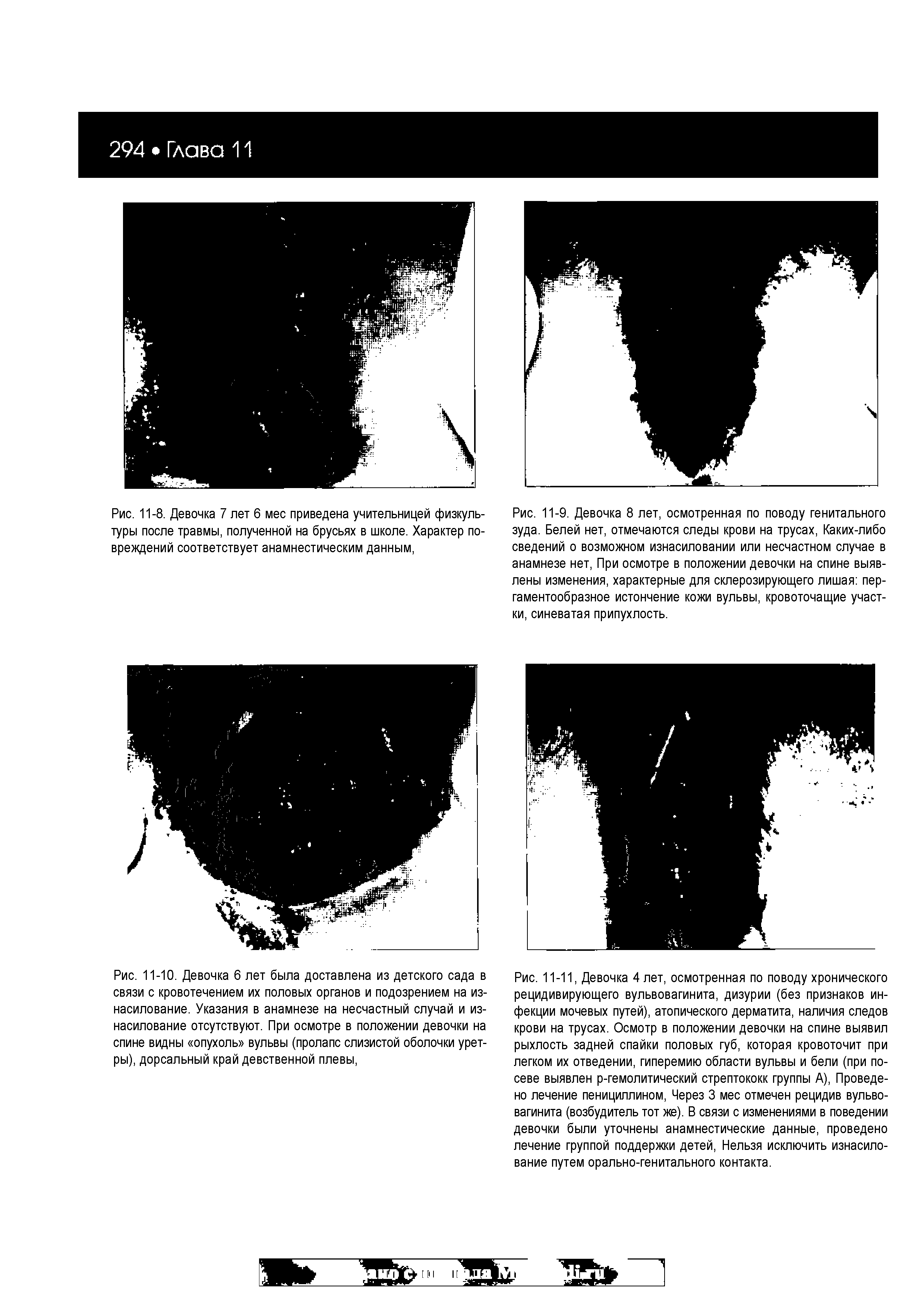 Рис. 11-10. Девочка 6 лет была доставлена из детского сада в связи с кровотечением их половых органов и подозрением на изнасилование. Указания в анамнезе на несчастный случай и изнасилование отсутствуют. При осмотре в положении девочки на спине видны опухоль вульвы (пролапс слизистой оболочки уретры), дорсальный край девственной плевы,...