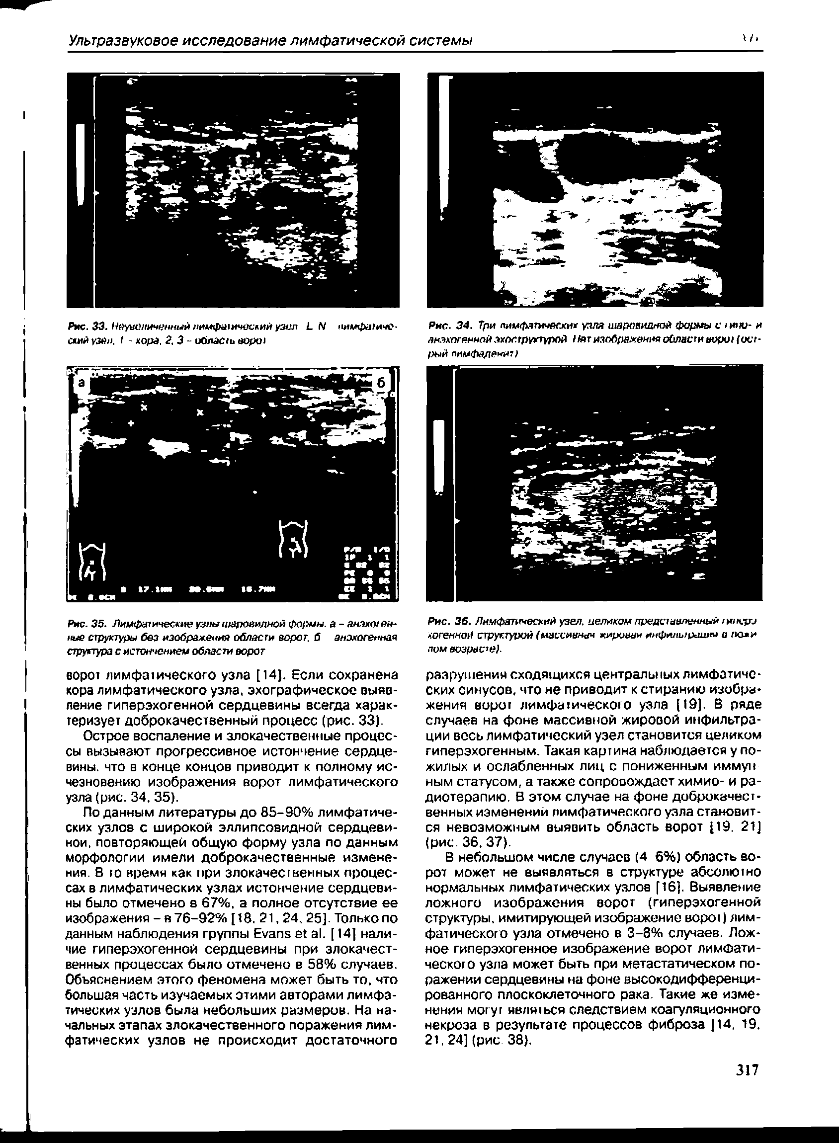 Рис. 36. Лимфатический узел, целиком предсчхаленный . осенней структурой (массивна кирива инфильржшин и лом возрасте).