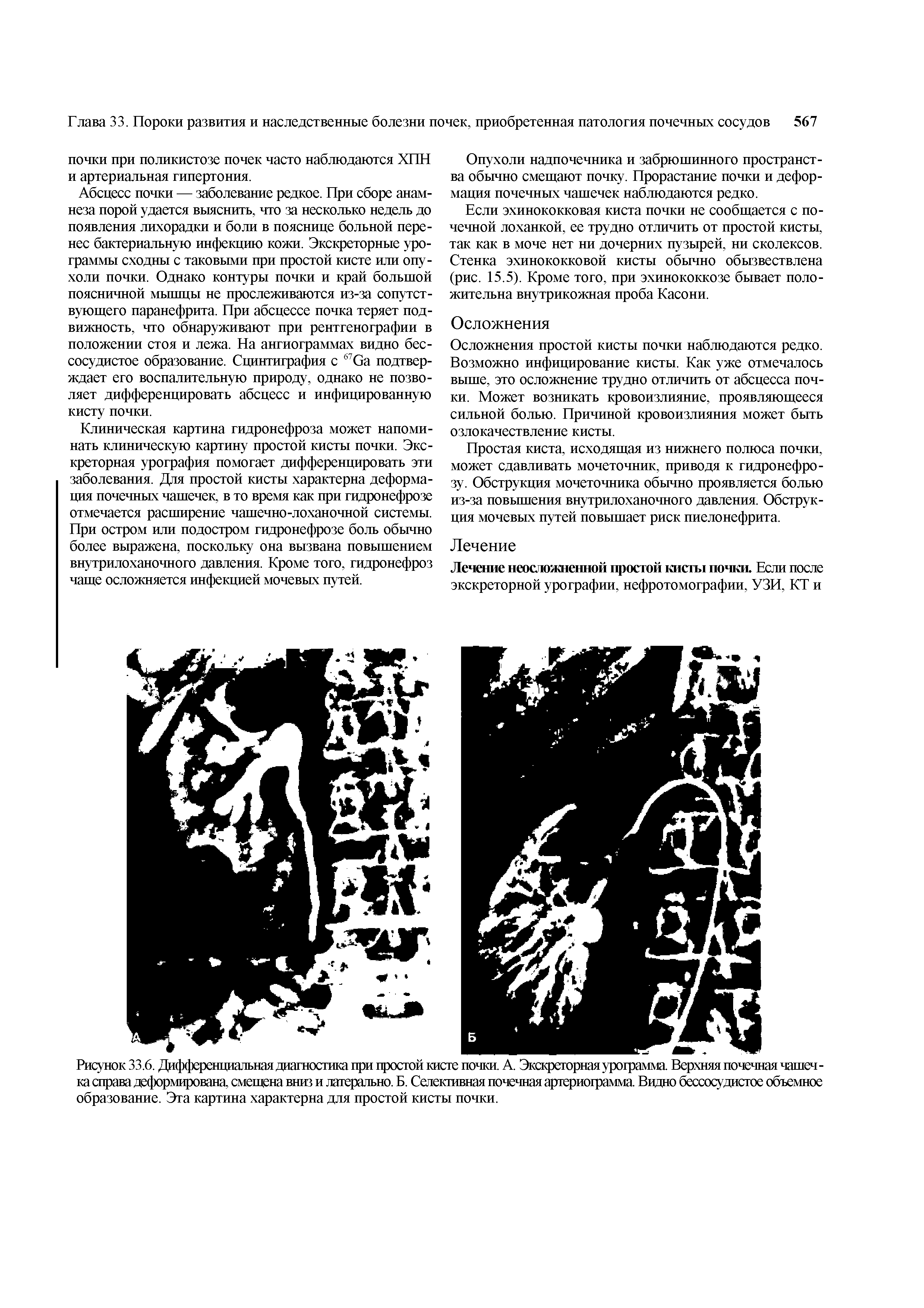 Рисунок 33.6. Дифференциальная диагностика при простой кисте почки. А. Экскреторная урограмма Верхняя почечная чашечка справа деформирована, смещена вниз и латерально. Б. Селективная почечная артериограмма Видно бессосудистое объемное образование. Эта картина характерна для простой кисты почки.