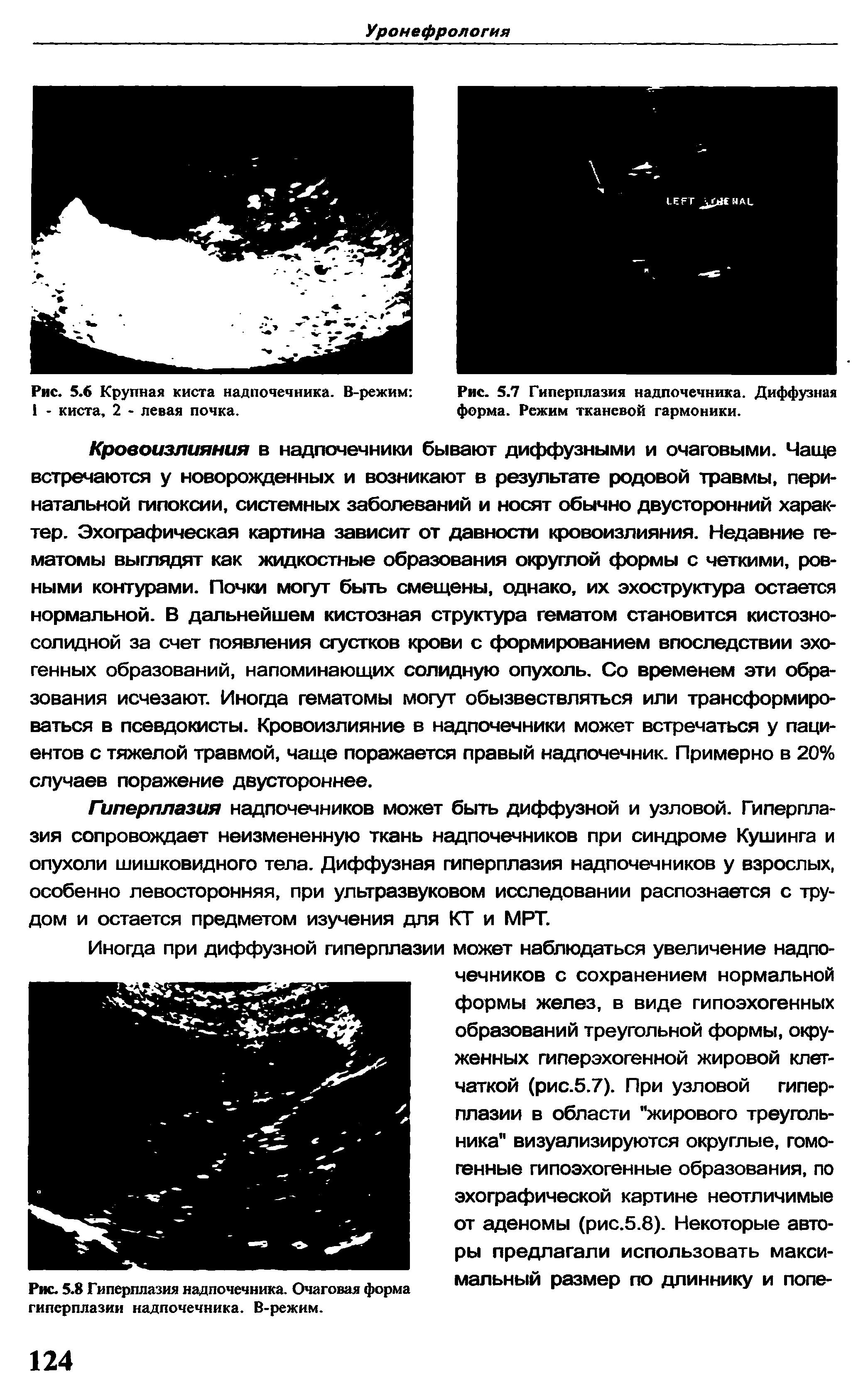 Рис. 5.6 Крупная киста надпочечника. В-режим 1 - киста, 2 - левая почка.