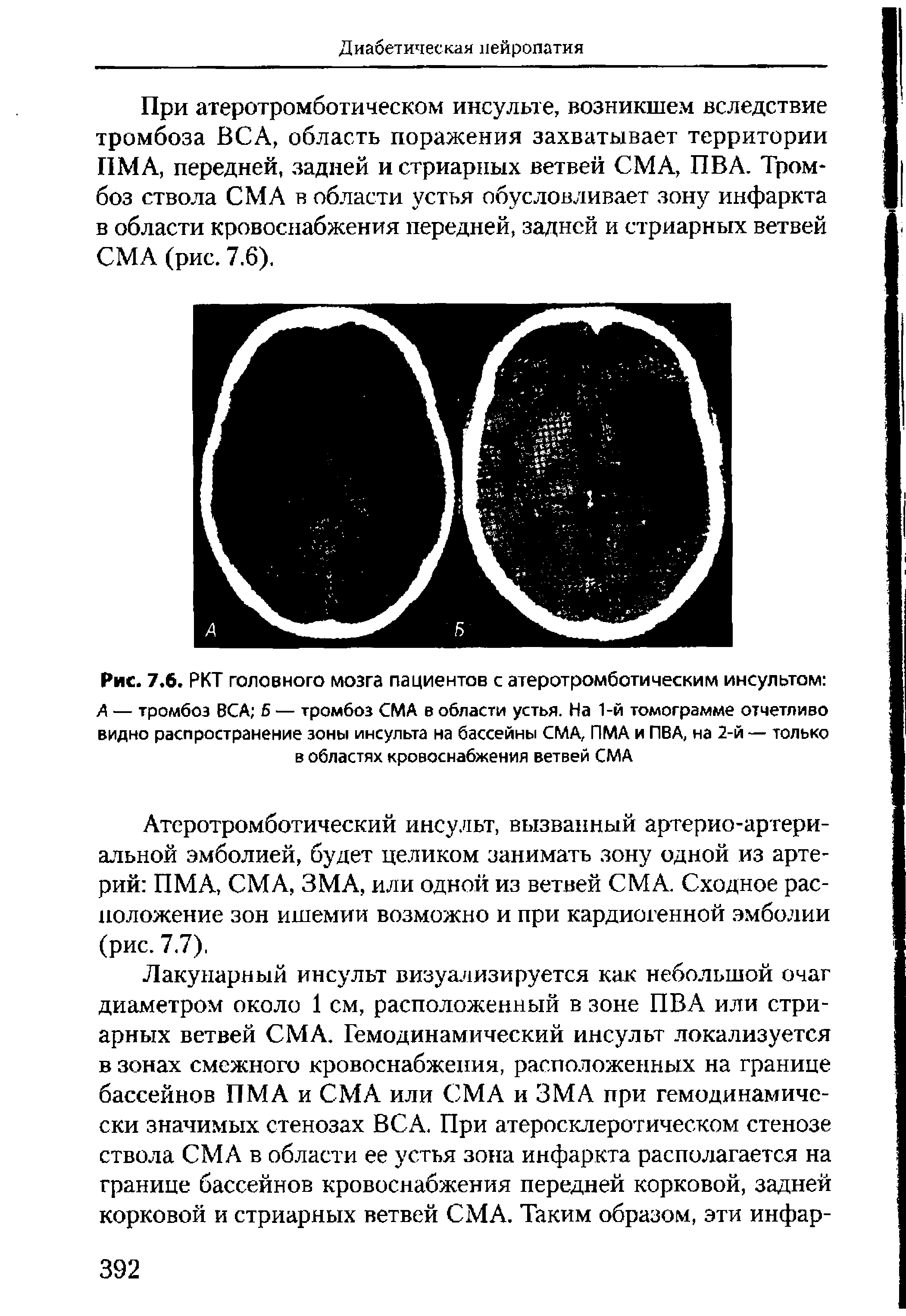 Рис. 7.6. РКТ головного мозга пациентов с атеротромботивеским инсультом А — тромбоз ВСА 5 — тромбоз СМА в области устья. На 1-й томограмме отчетливо видно распространение зоны инсульта на бассейны СМА, ПМА и ПВА, на 2-й — только в областях кровоснабжения ветвей СМА...