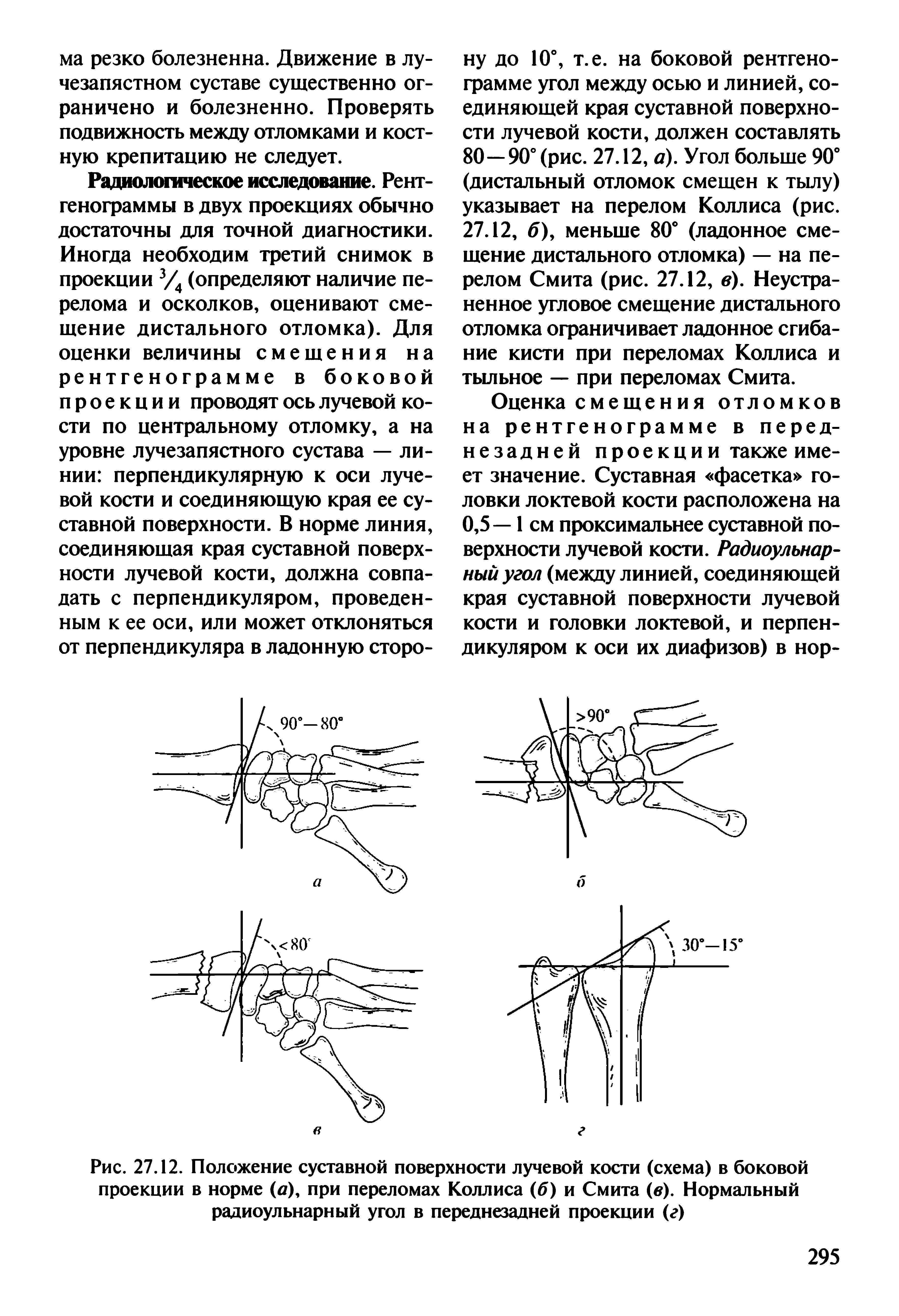 Рис. 27.12. Положение суставной поверхности лучевой кости (схема) в боковой проекции в норме (а), при переломах Коллиса (б) и Смита (в). Нормальный радиоульнарный угол в переднезадней проекции (г)...