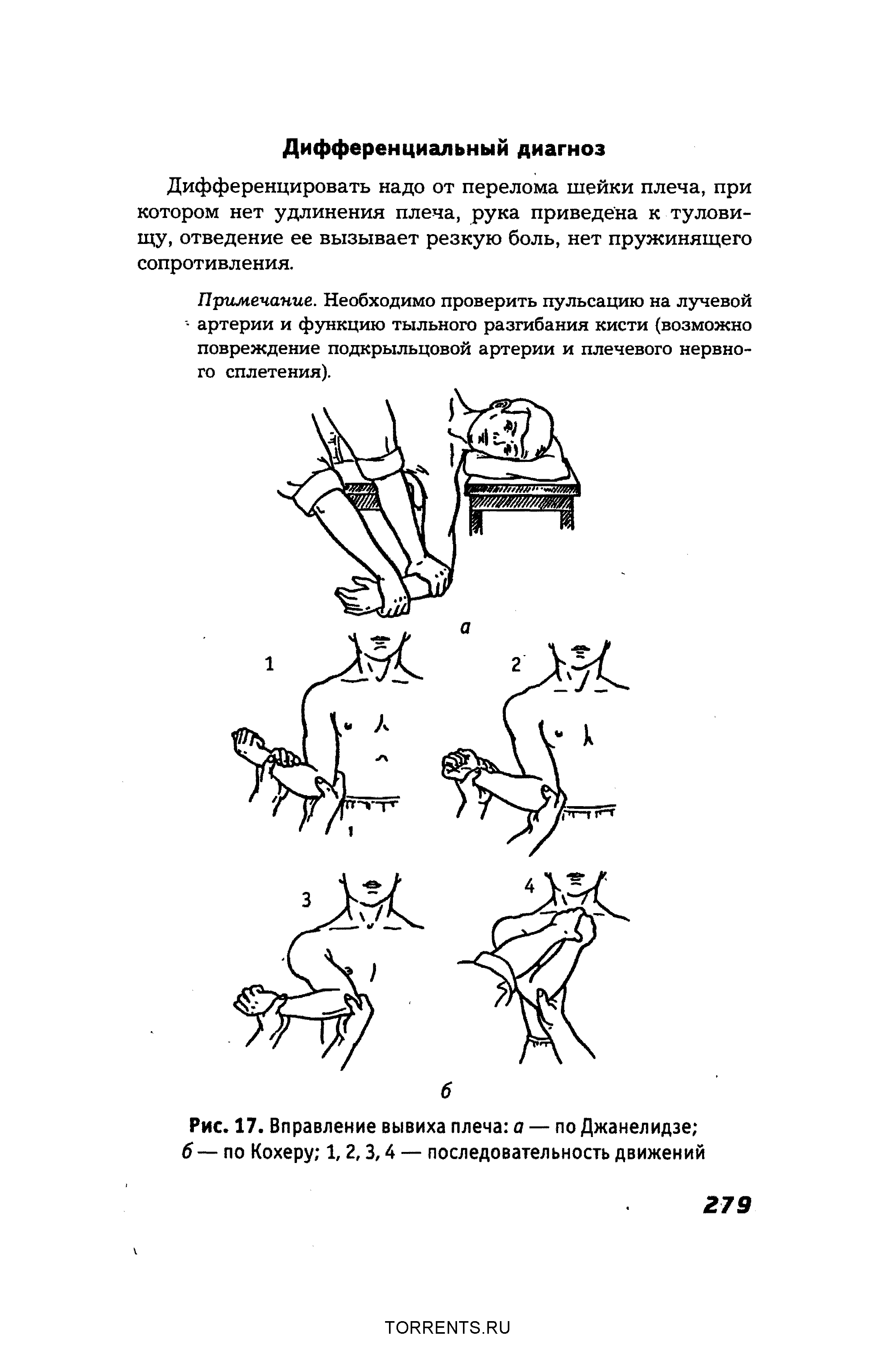 Рис. 17. Вправление вывиха плеча а — по Джанелидзе б — по Кохеру 1,2,3,4 — последовательность движений...