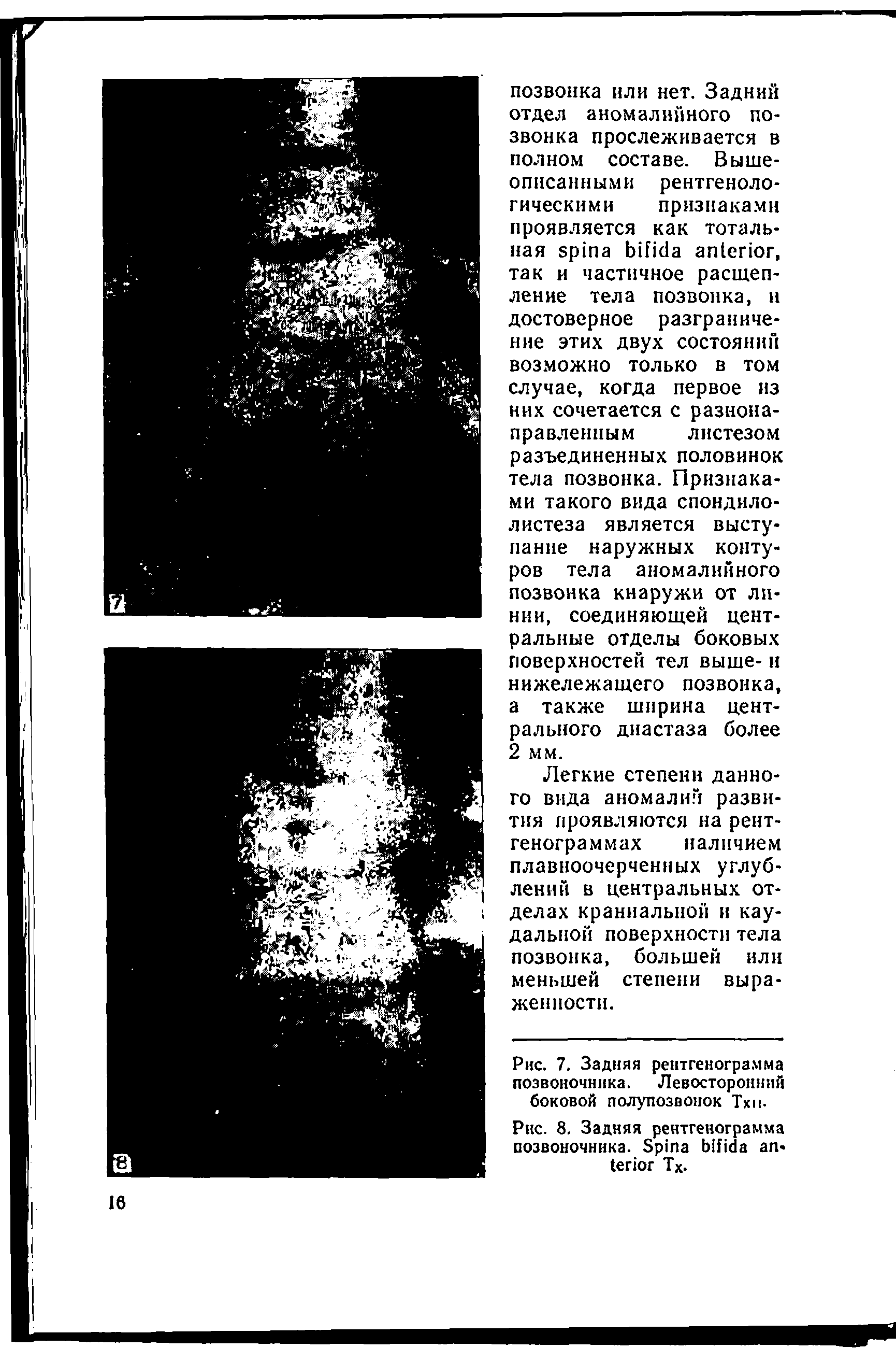 Рис. 7. Задняя рентгенограмма позвоночника. Левосторонний боковой полупозвонок Тхн-...