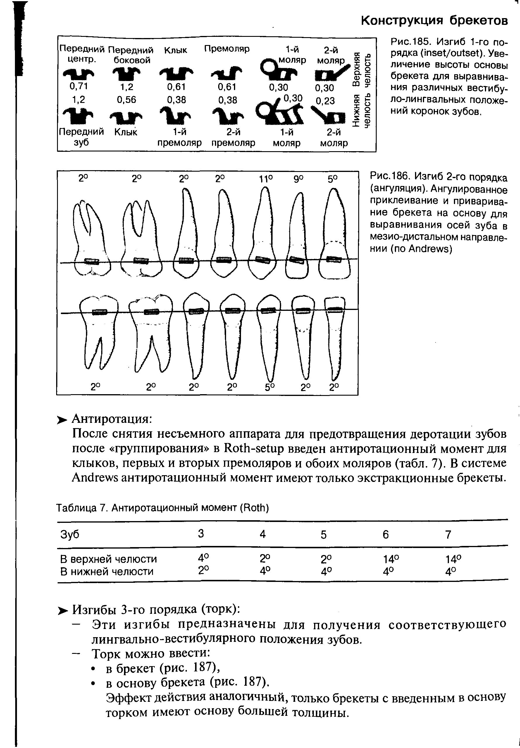 Рис. 186. Изгиб 2-го порядка (ангуляция). Ангулированное приклеивание и приваривание брекета на основу для выравнивания осей зуба в мезио-дистальном направлении (по A )...