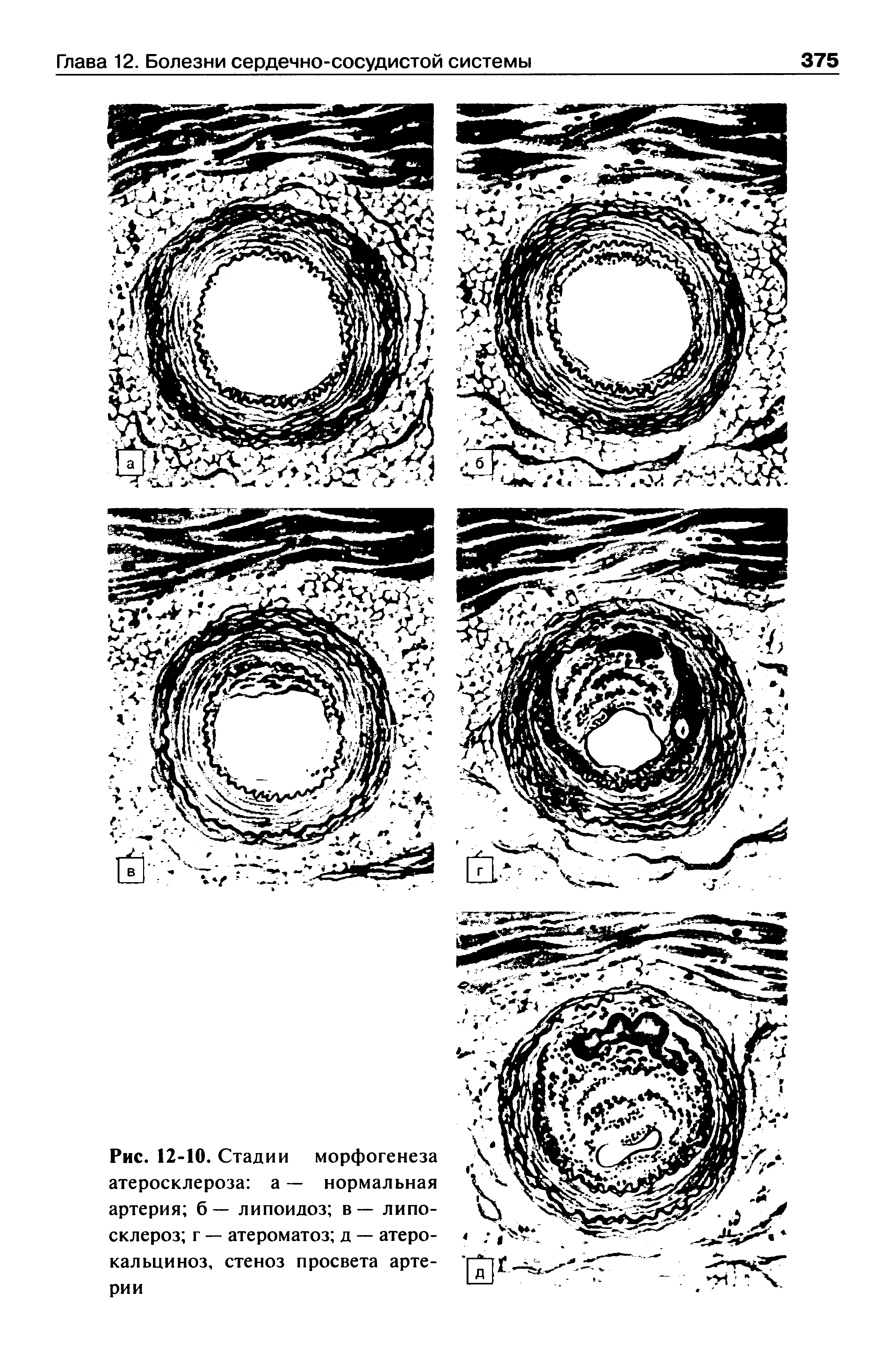 Рис. 12-10. Стадии морфогенеза атеросклероза а — нормальная артерия б — липоидоз в — липо-склероз г — атероматоз д — атеро-кальциноз, стеноз просвета артерии...