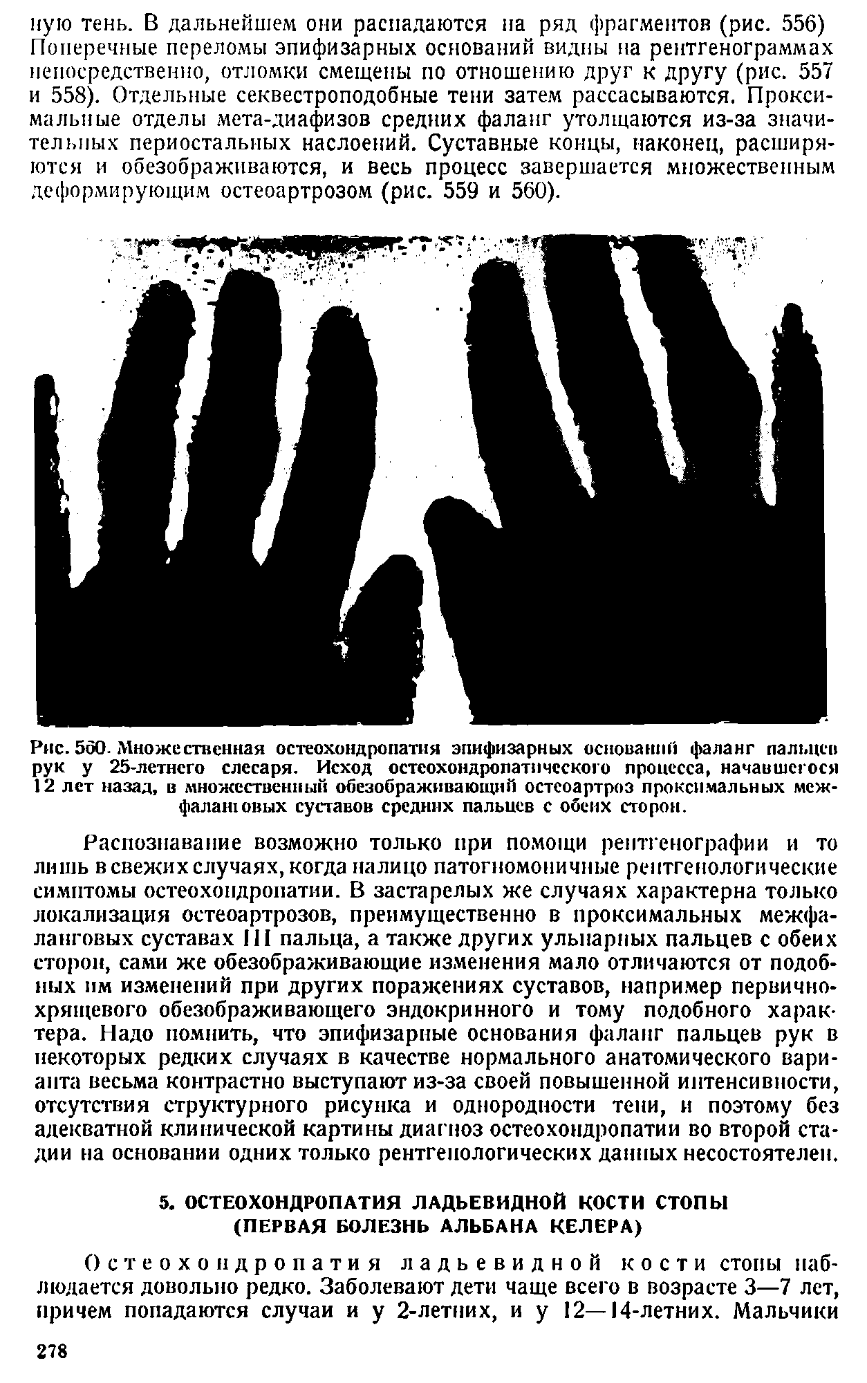 Рис. 560. Множественная остеохондропатия эпифизарных оснований фаланг пальцев рук у 25-летнего слесаря. Исход остеохондропатпческого процесса, начавшегося 12 лет назад, в множественный обезображивающий остеоартроз проксимальных меж-фалаиювых суставов средних пальцев с обеих сторон.