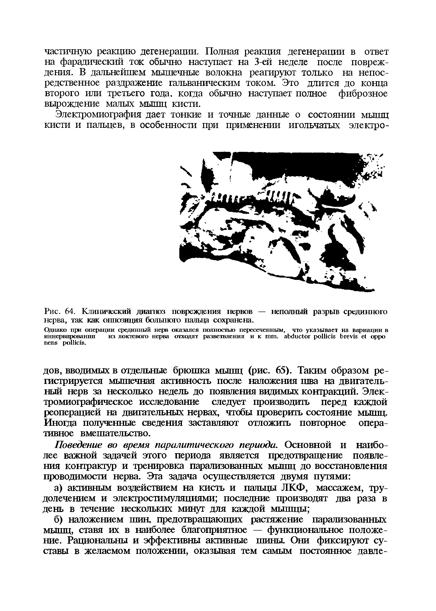 Рис. 64. Клинический диагноз повреждения нервов — неполный разрыв срединного нерва, так как оппозиция большого пальца сохранена.