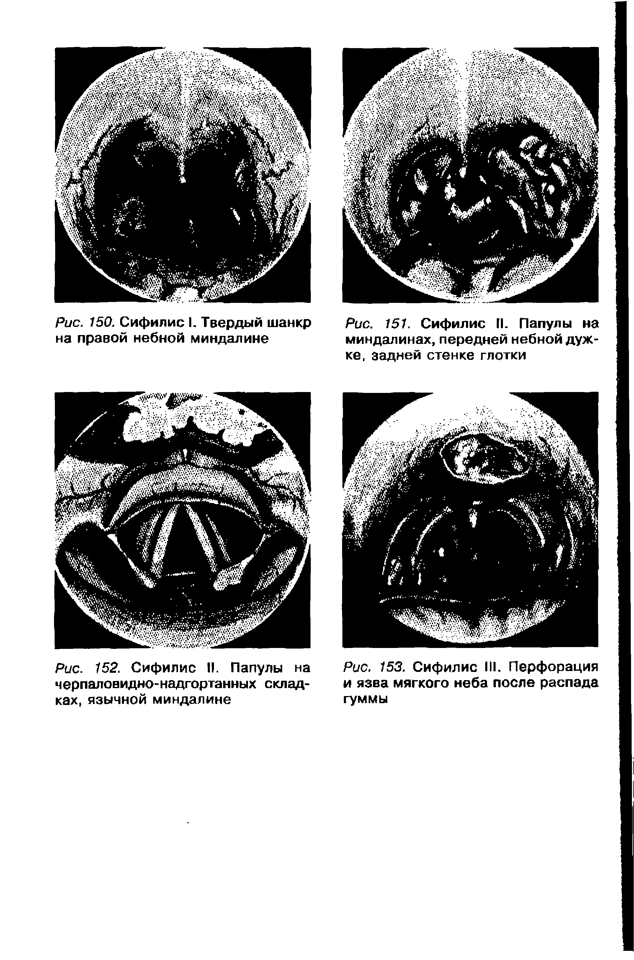 Рис. 152. Сифилис II. Папулы на черпаловидно-надгортанных складках, язычной миндалине...