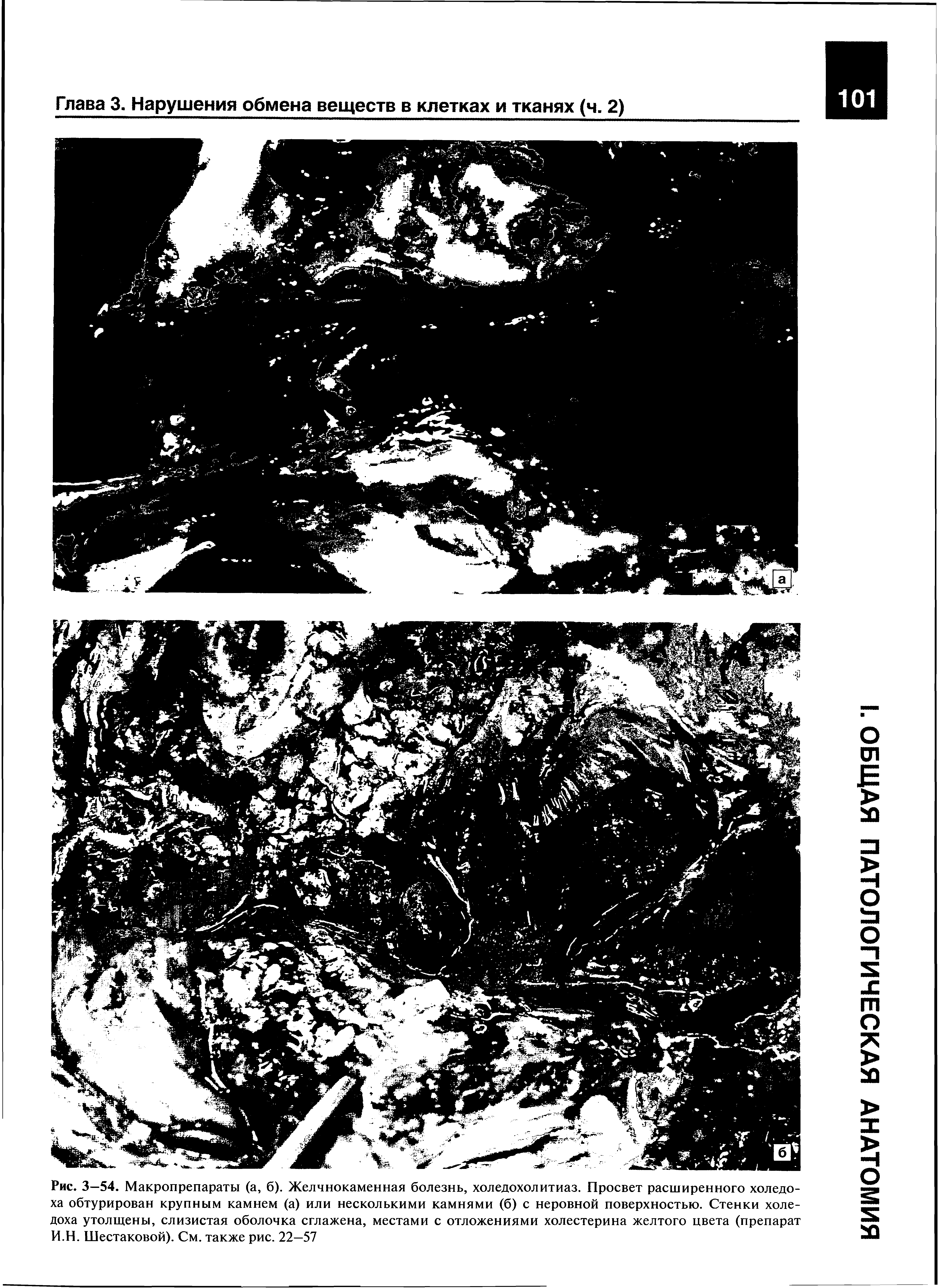 Рис. 3—54. Макропрепараты (а, б). Желчнокаменная болезнь, холедохолитиаз. Просвет расширенного холедоха обтурирован крупным камнем (а) или несколькими камнями (б) с неровной поверхностью. Стенки холедоха утолщены, слизистая оболочка сглажена, местами с отложениями холестерина желтого цвета (препарат И.Н. Шестаковой). См. также рис. 22—57...