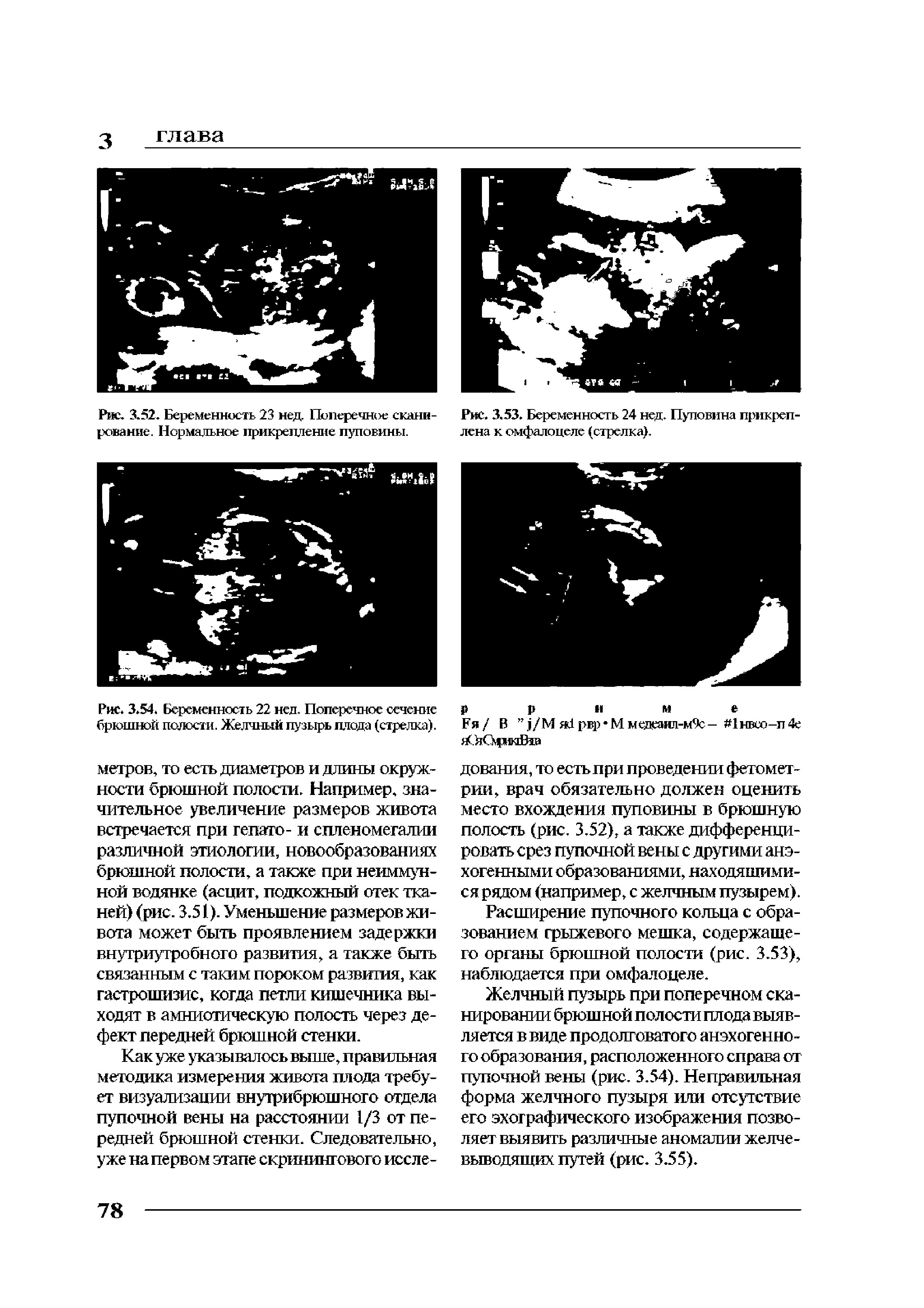 Рис. 3.54. Беременность 22 нед. Поперечное сечение брюшной полости. Желчный пузырь плода (стрелка), метров, то есть диаметров и длины окружности брюшной полости. Например, зна-...