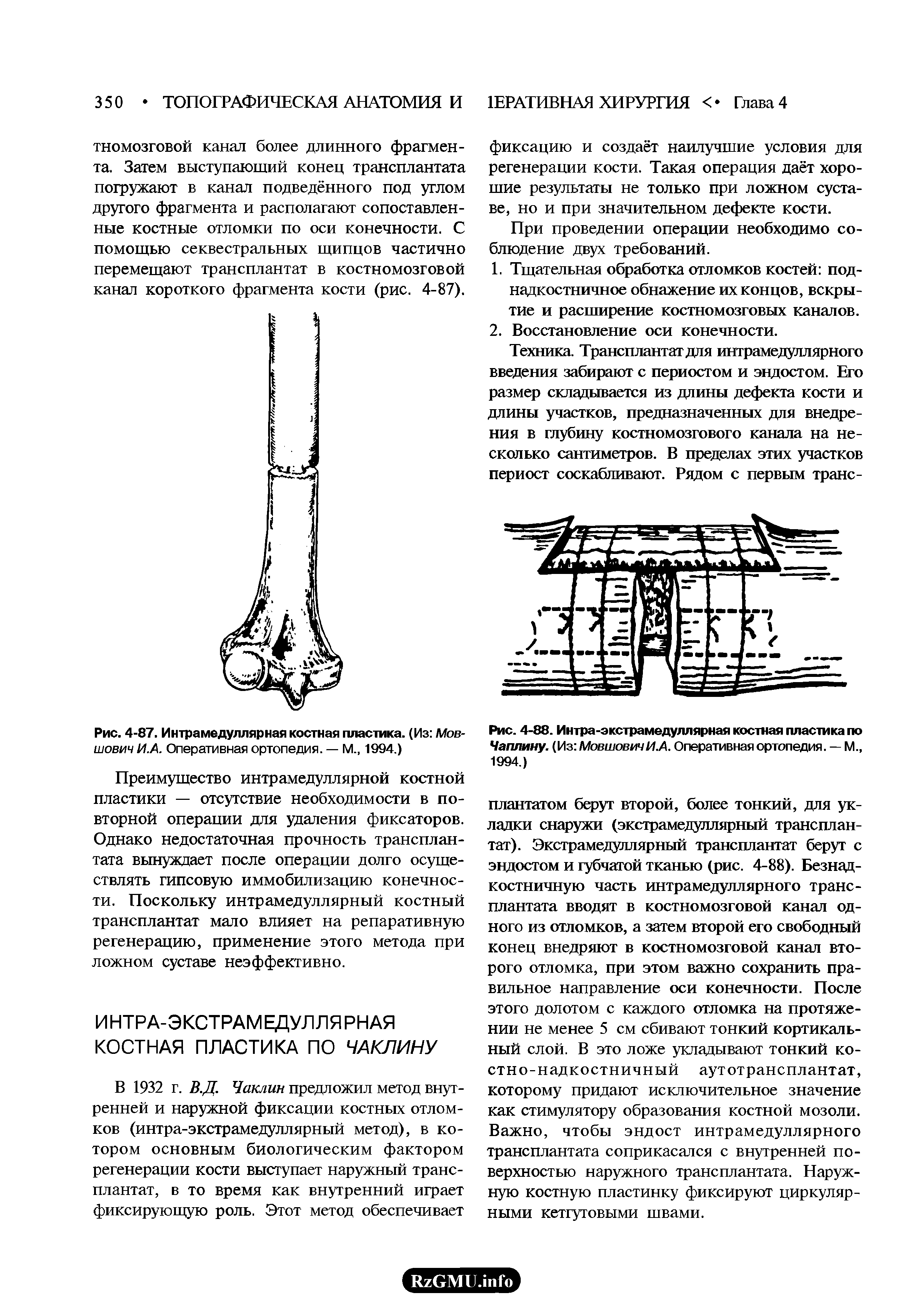 Рис. 4-87. Интрамедуллярная костная пластика. (Из Мов-шович И.А. Оперативная ортопедия. — М., 1994.)...