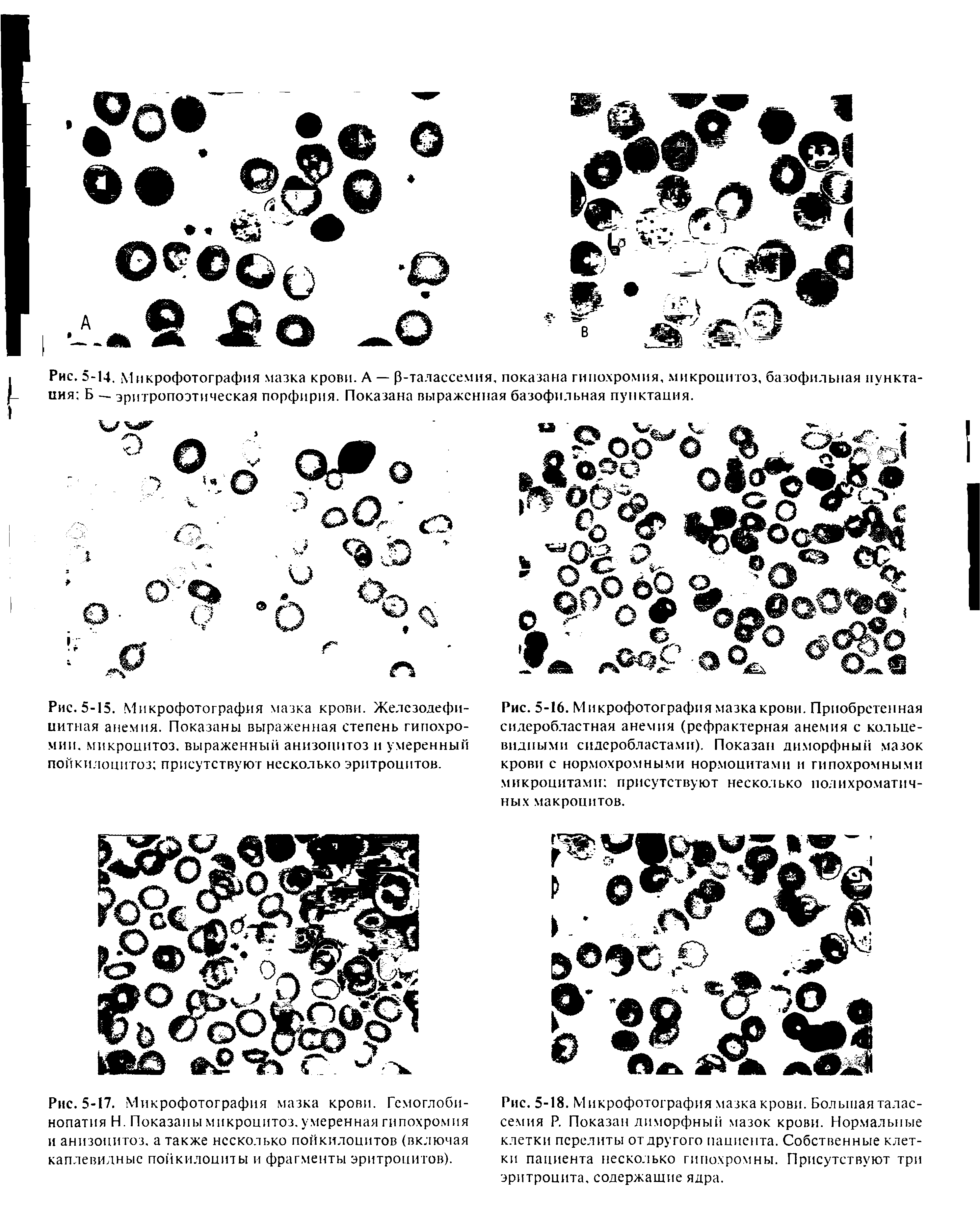 Рис. 5-17. Микрофотография мазка крови. Гемоглобинопатия Н. Показаны микроцитоз, умеренная гипохромия и анизоцитоз, а также несколько пойкилоцитов (включая каплевидные пойкилоциты и фрагменты эритроцитов).