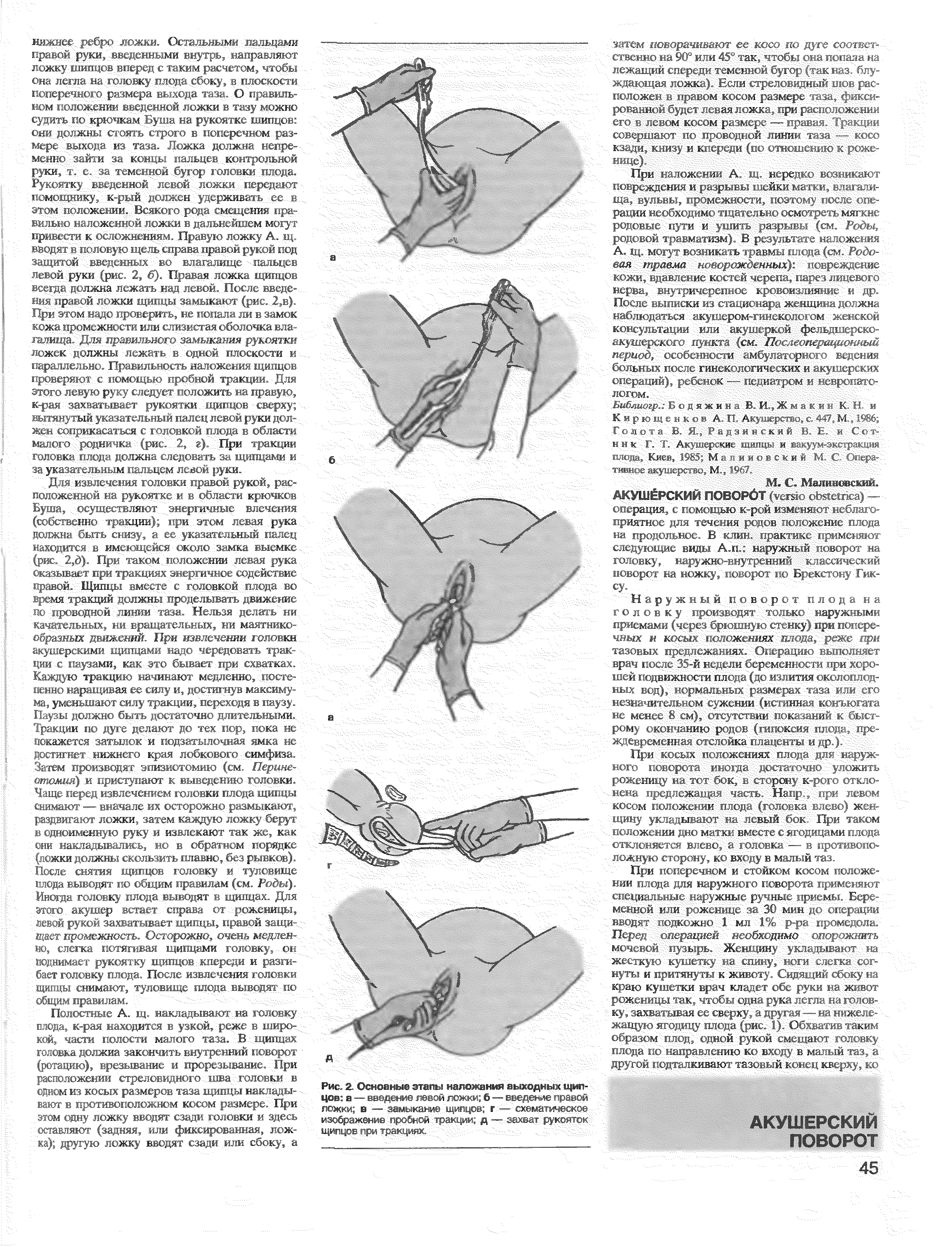 Рис. 2. Основные этапы наложения аыходнь щипцов а — введение левой ложки б — введение правой ложки в -—- замыкание щипцов г-—схематическое изображение пробной тракции д — захват рукояток щипцов при тракциях.