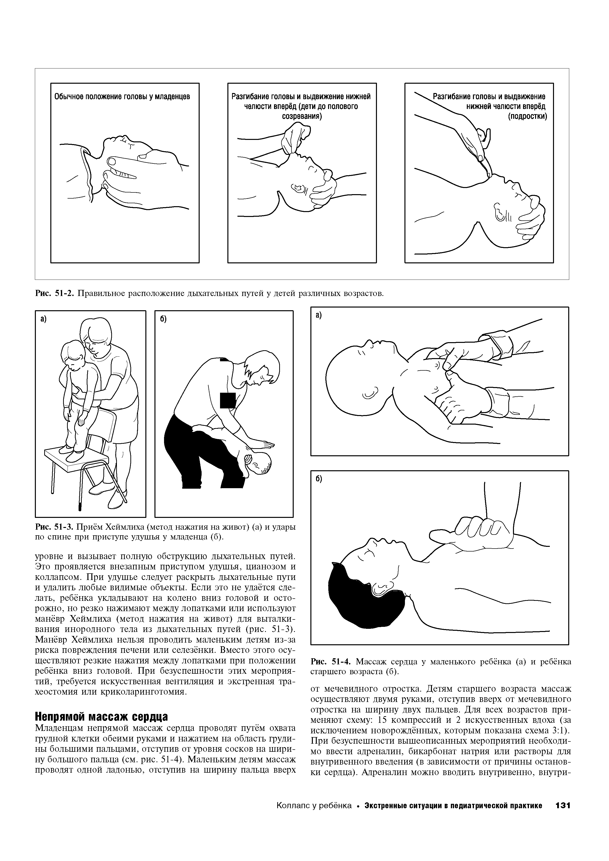 Рис. 51-3. Приём Хеймлиха (метод нажатия на живот) (а) и удары по спине при приступе удушья у младенца (б).