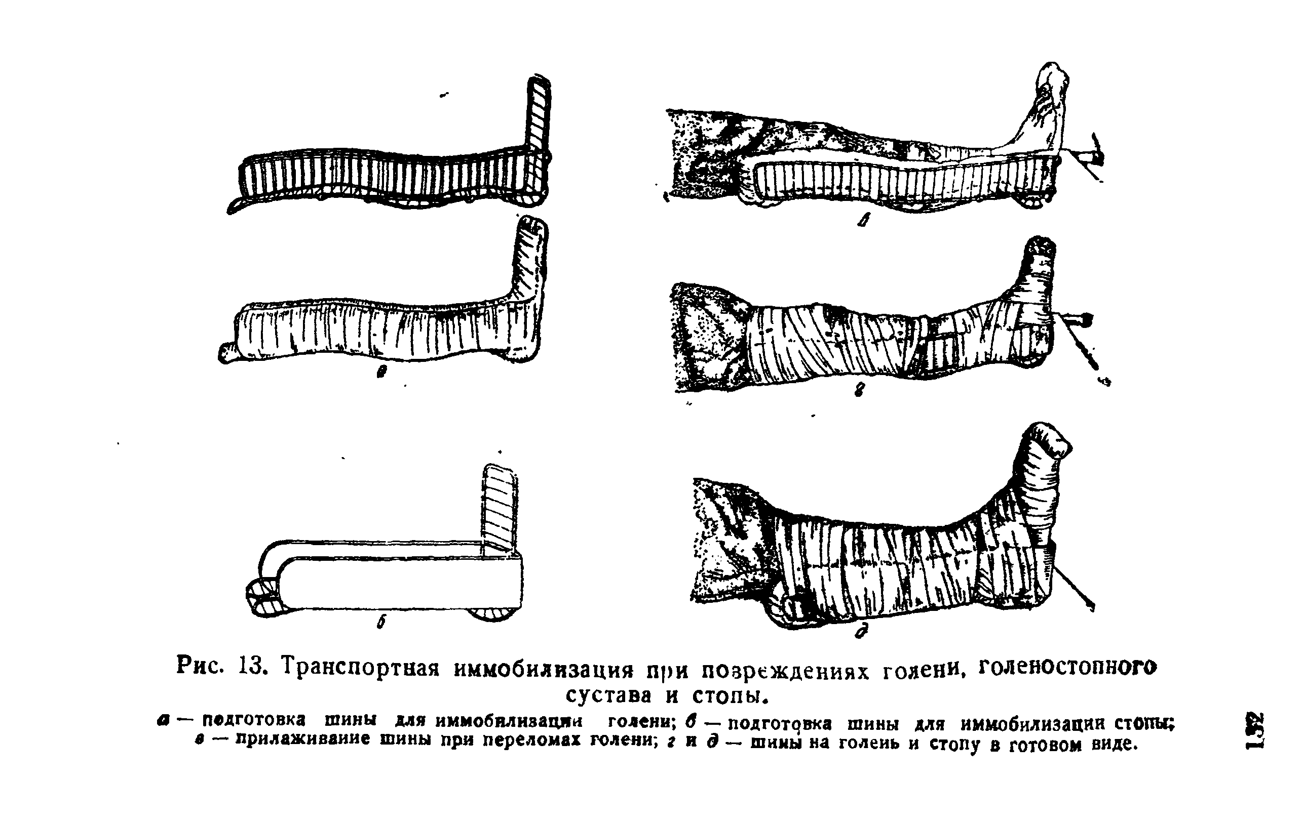 Рис. 13. Транспортная иммобилизация при повреждениях голени, голеностопного сустава и стопы.