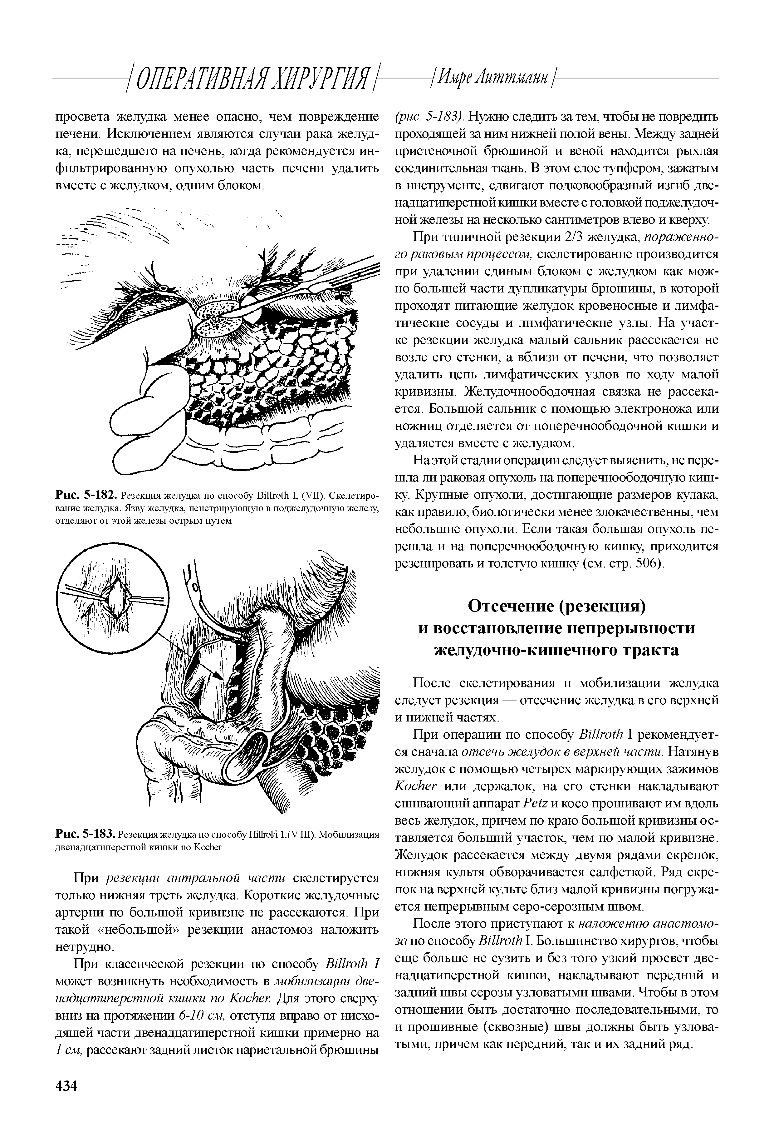 Рис. 5-182. Резекция желудка по способу B I, (VII). Скелетирование желудка. Язву желудка, пенетрирующую в поджелудочную железу, отделяют от этой железы острым путем...