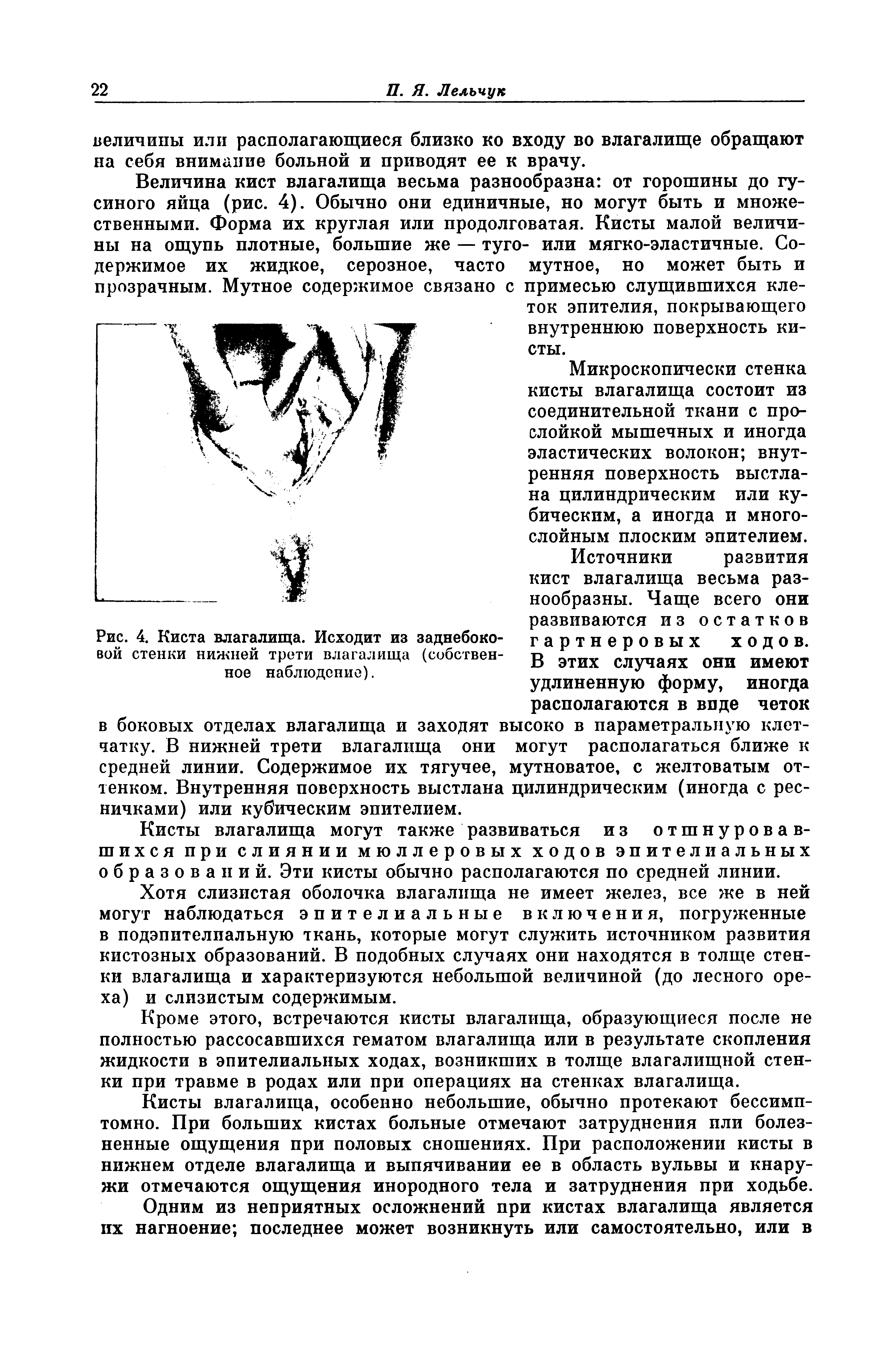 Рис. 4. Киста влагалища. Исходит из заднебоковой стенки нижней трети влагалища (собственное наблюдение).