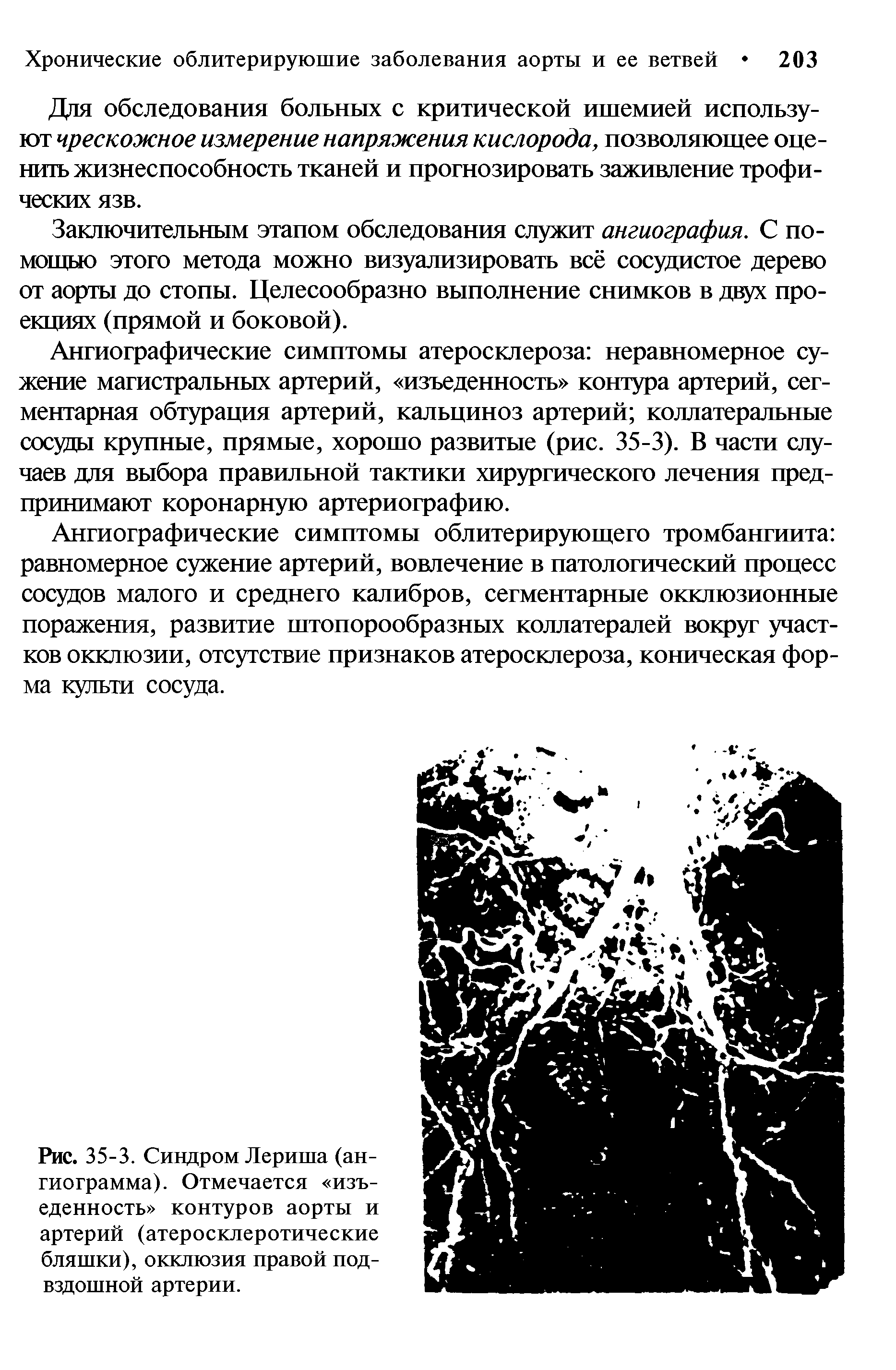 Рис. 35-3. Синдром Лериша (ангиограмма). Отмечается изъеденность контуров аорты и артерий (атеросклеротические бляшки), окклюзия правой подвздошной артерии.