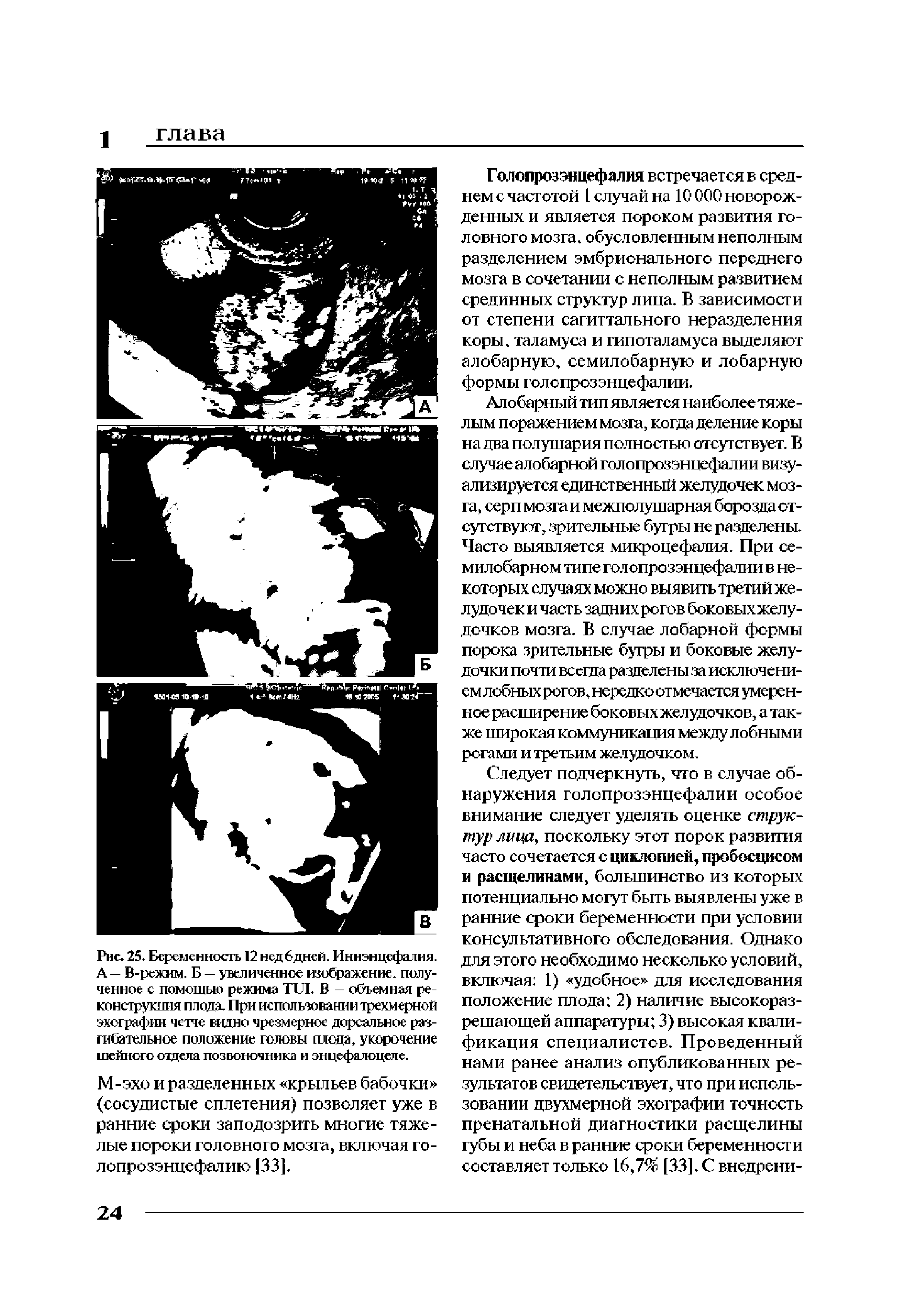 Рис. 25. Беременность 12 недбдней. Иниэнцефалия. А — В-режим. Б — увеличенное изображение, полученное с помощью режима TUI. В - объемная реконструкция плода. При использовании трехмерной эхографии четче видно чрезмерное дорсальное разгибательное положение головы плода, укорочение шейного отдела позвоночника и энцефалоцеле.